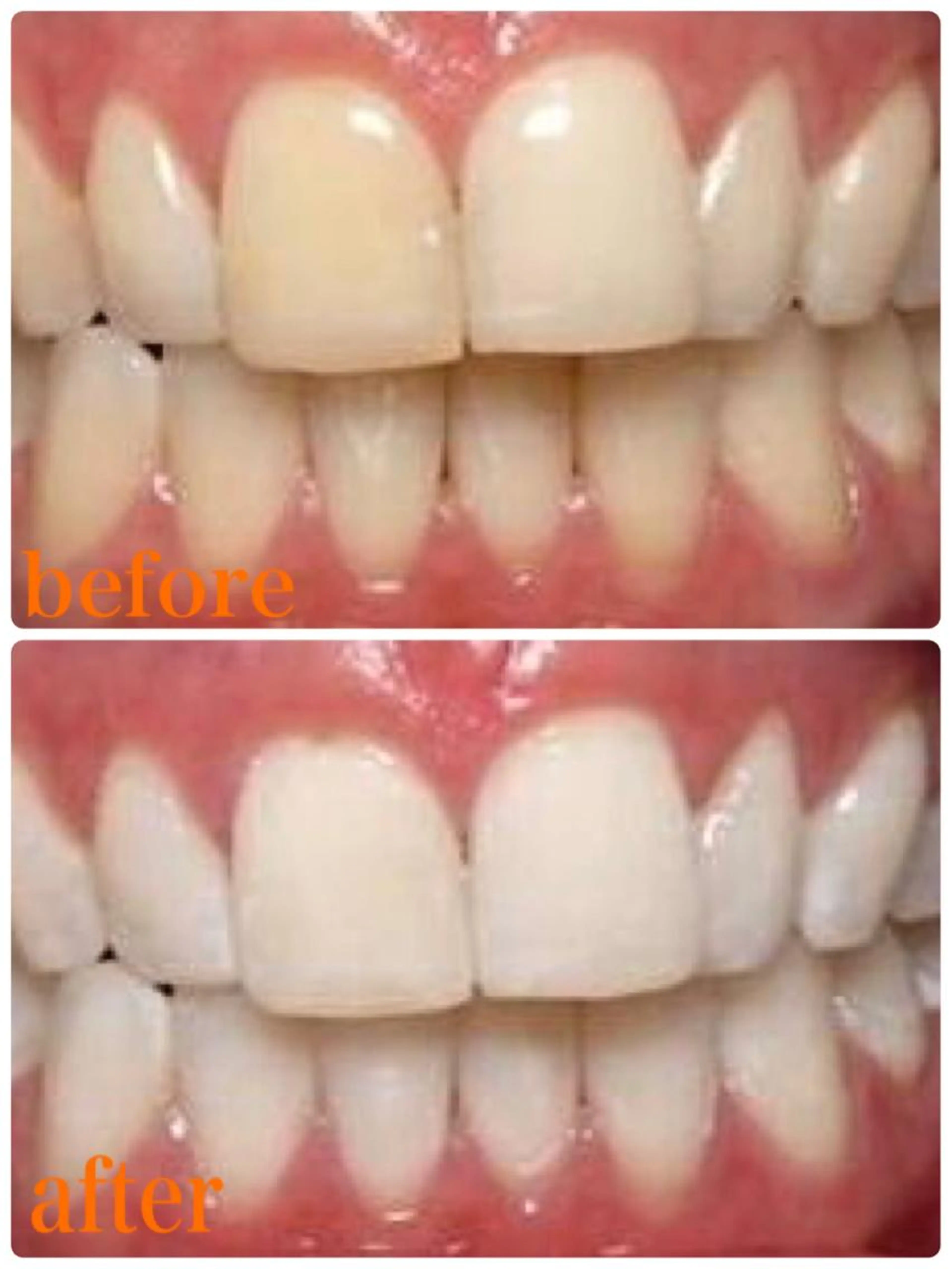 ✨つるつるぴかぴかモテtooth✨♡セルフホワイトニング♡の写真