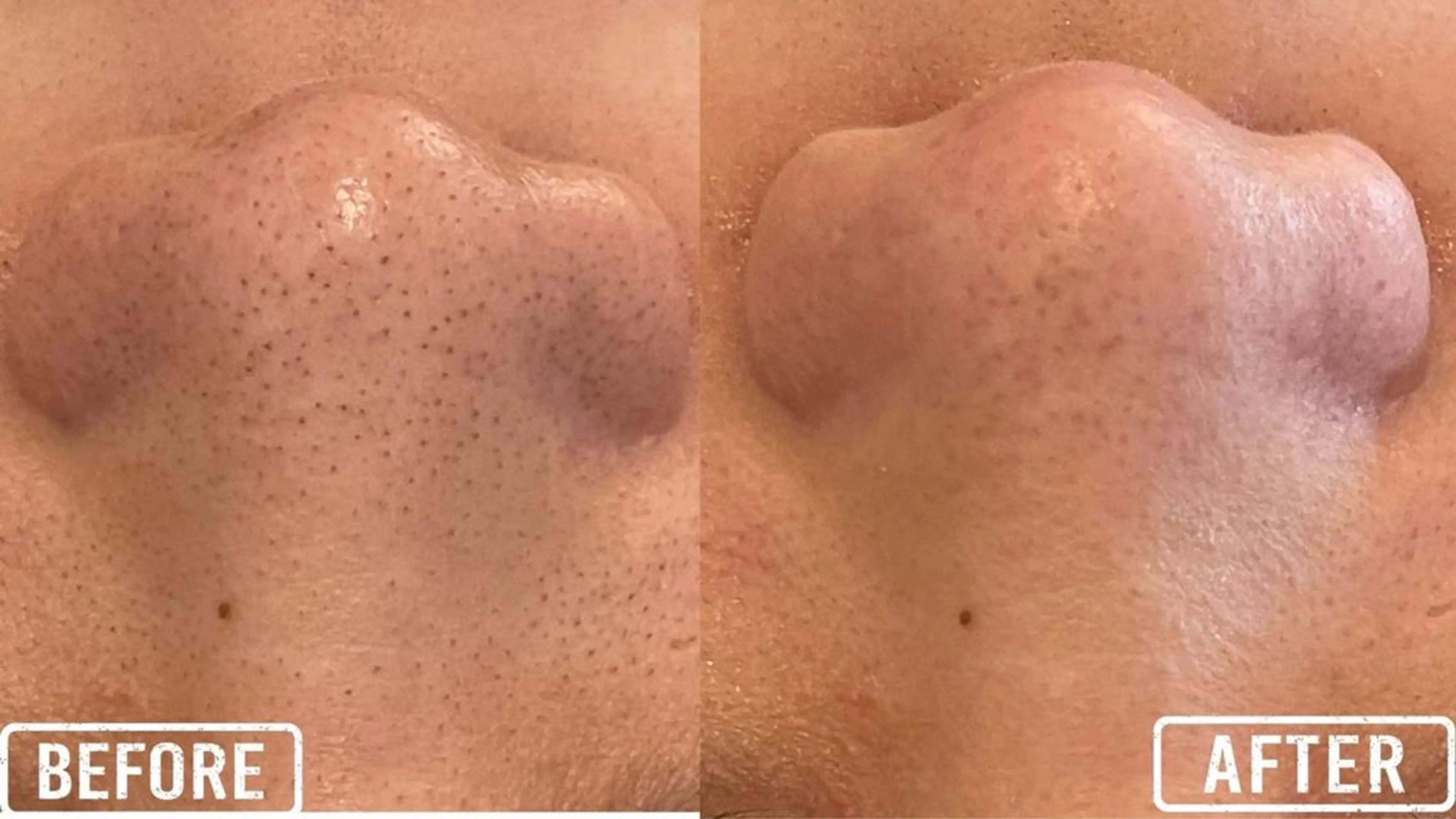 エステ 毛穴/毛穴洗浄専門 エミルカ船橋のエステ・リラクイメージ