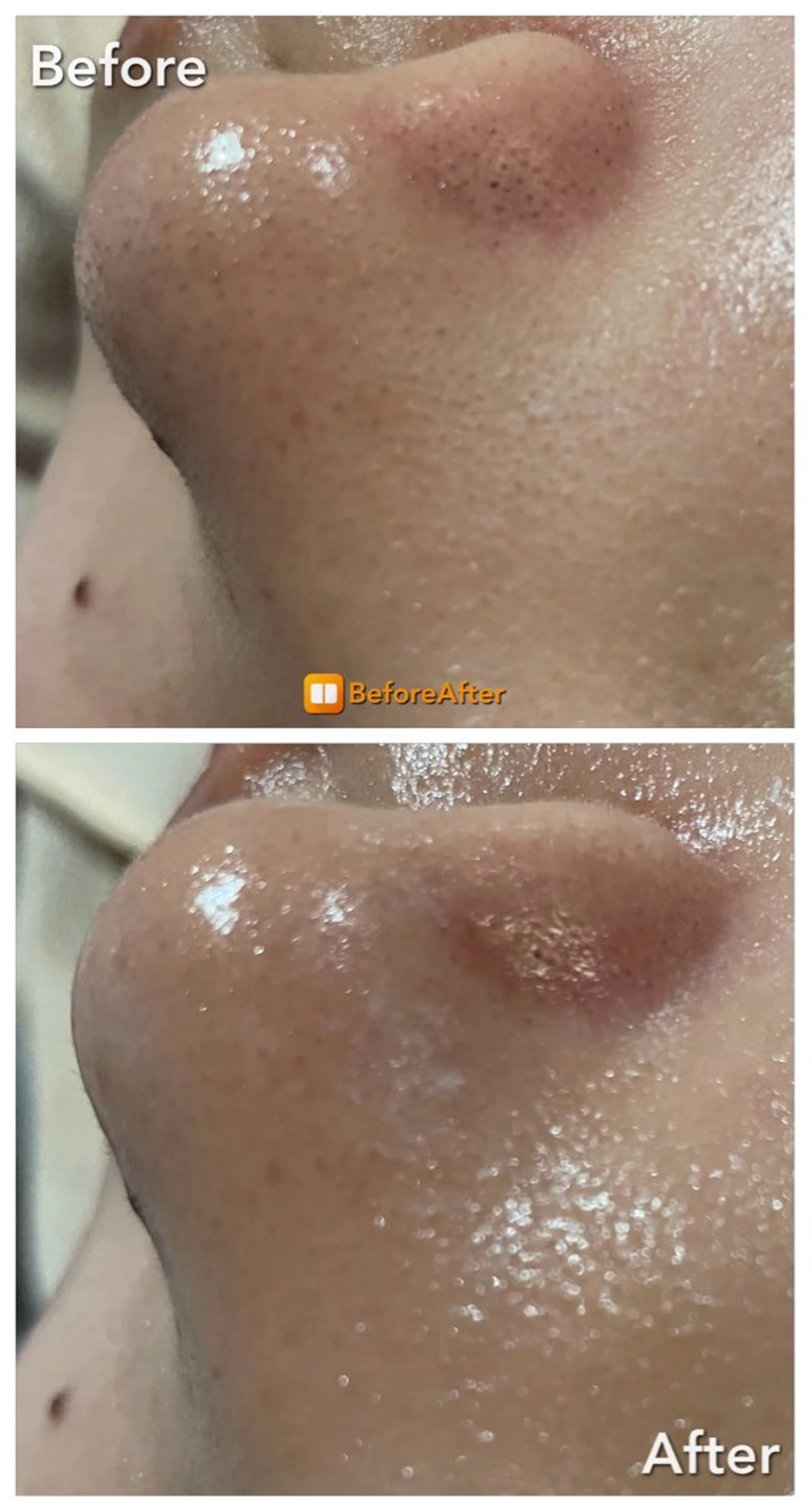 エステ Meupニキビ専門店 背中/ハーブ/肌管理のその他イメージ