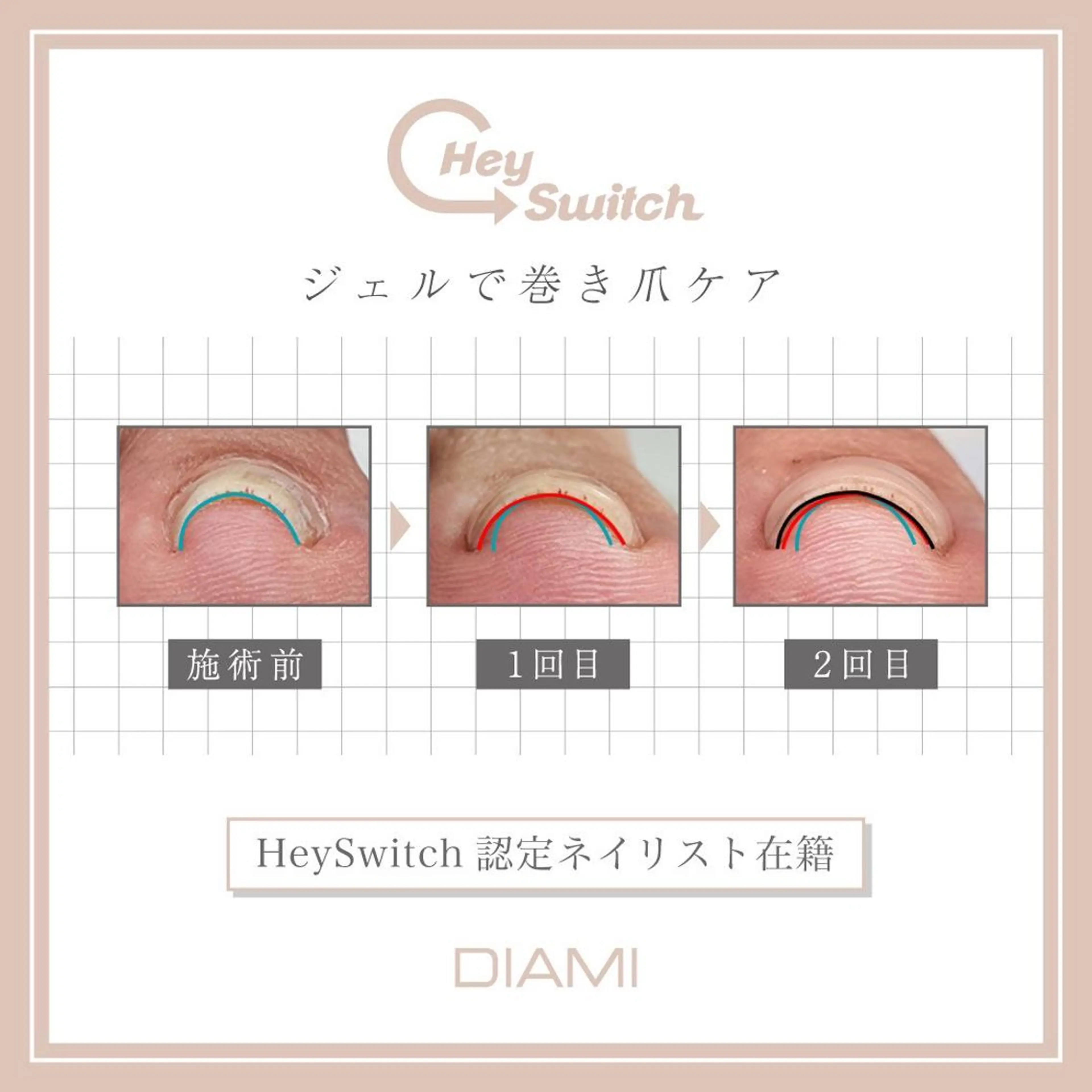 巻き爪ケア1本【Hey Switch】の写真