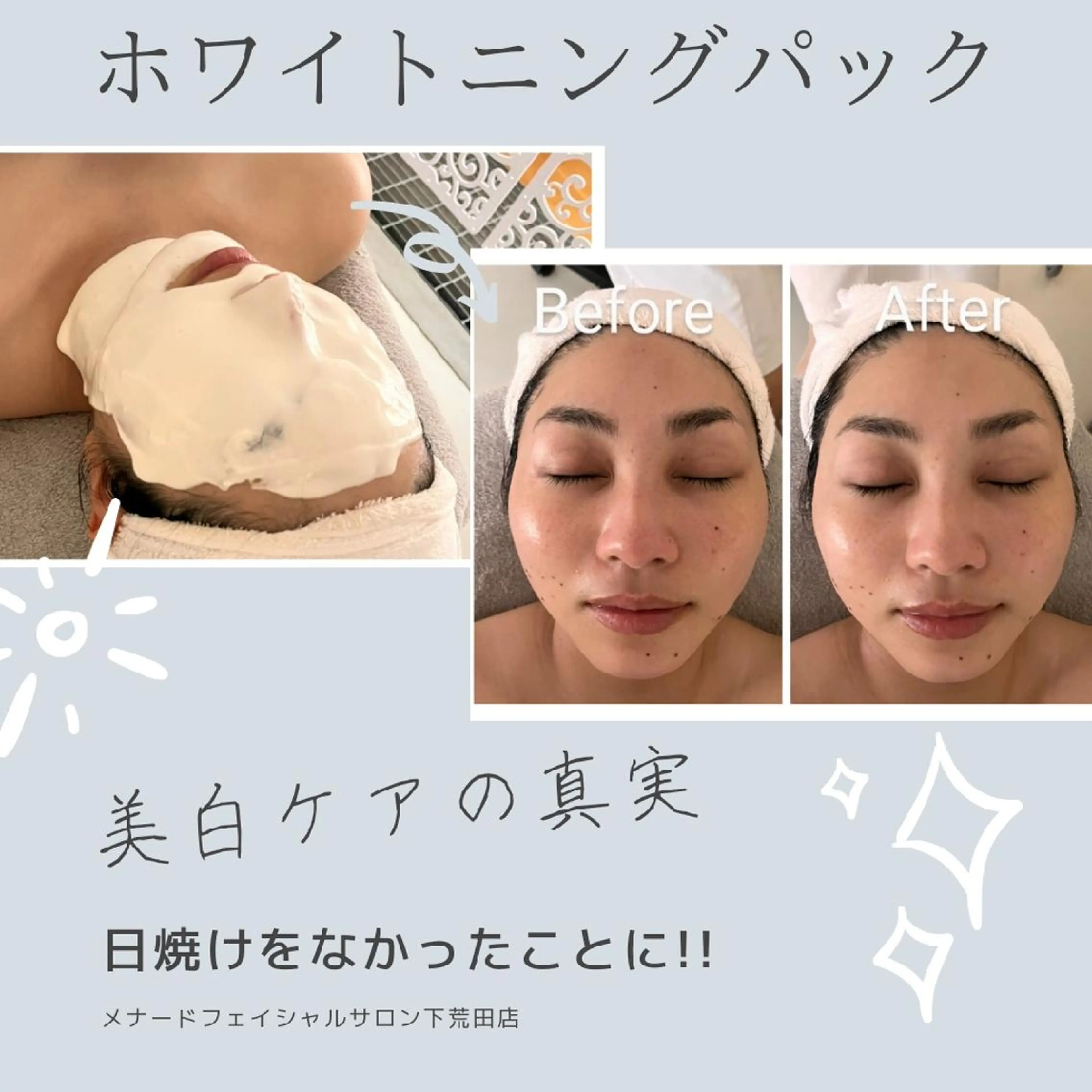 シミでお悩みの方のための美白ケアの写真