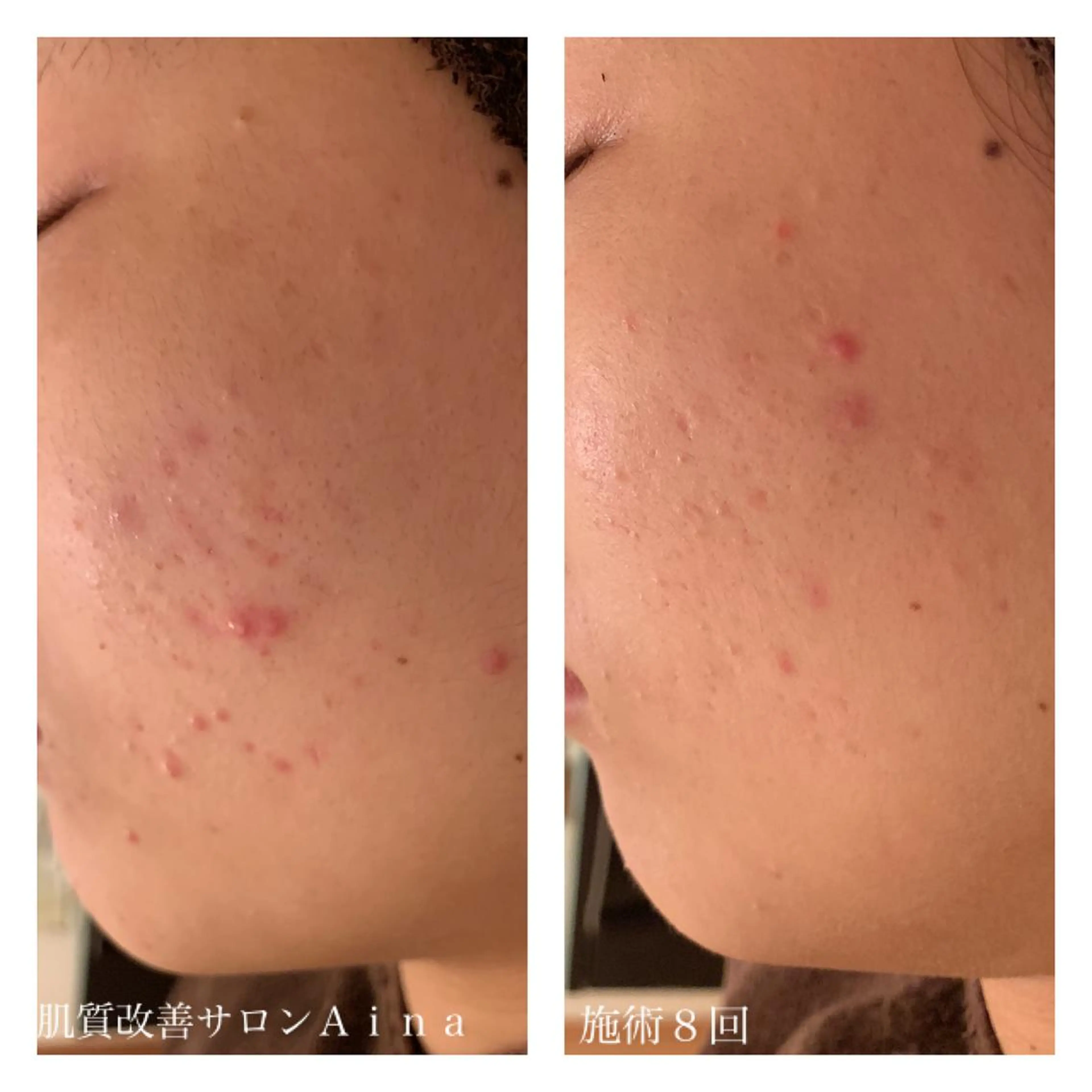 セミロング カラー パーマ ヘアアレンジ メンズ キッズ ネイル マツエク・マツパ ニキビ跡専門サロン Ａｉｎａのエステ・リラクイメージ