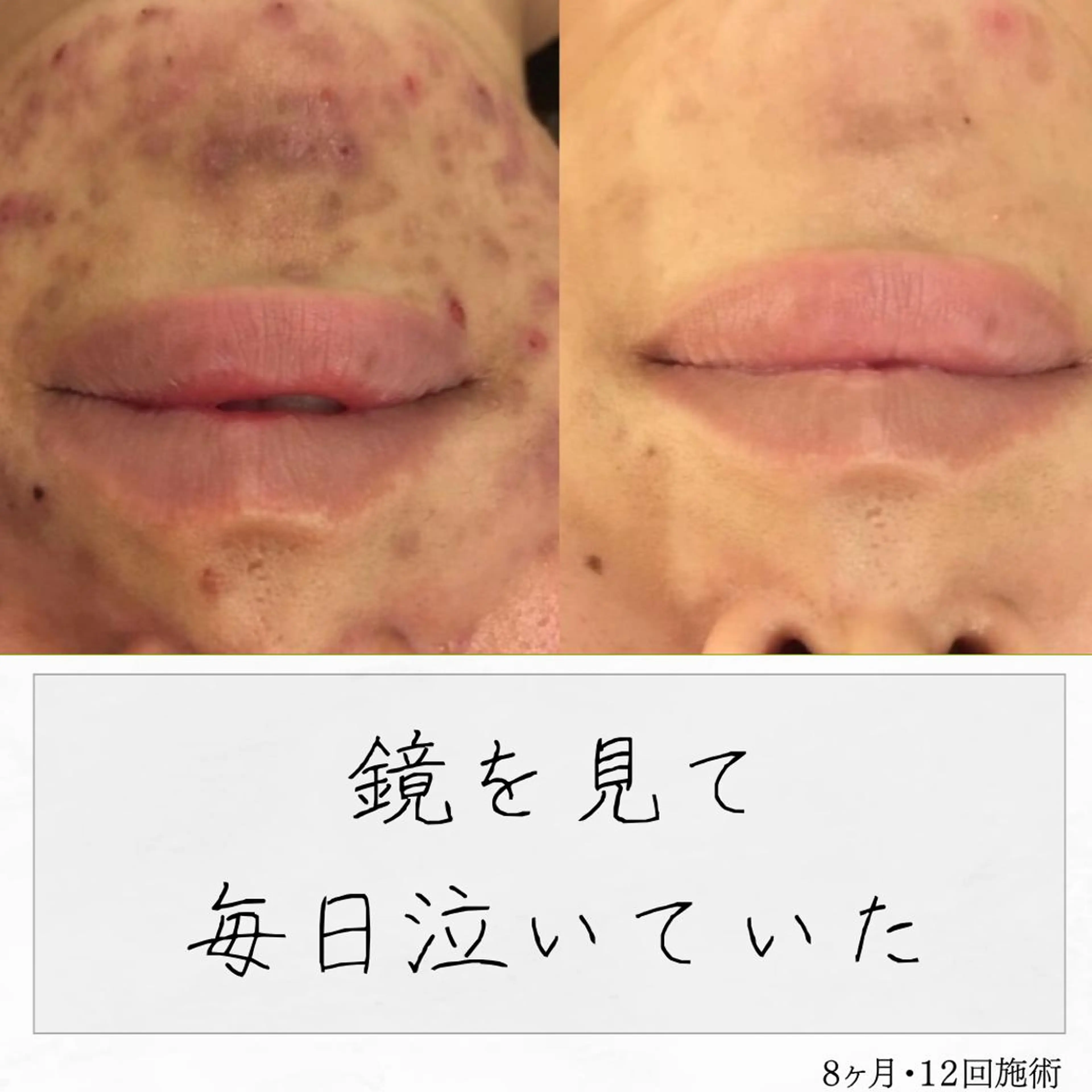 ニキビ経験者が施術 する専門サロン🌻のエステ・リラクイメージ