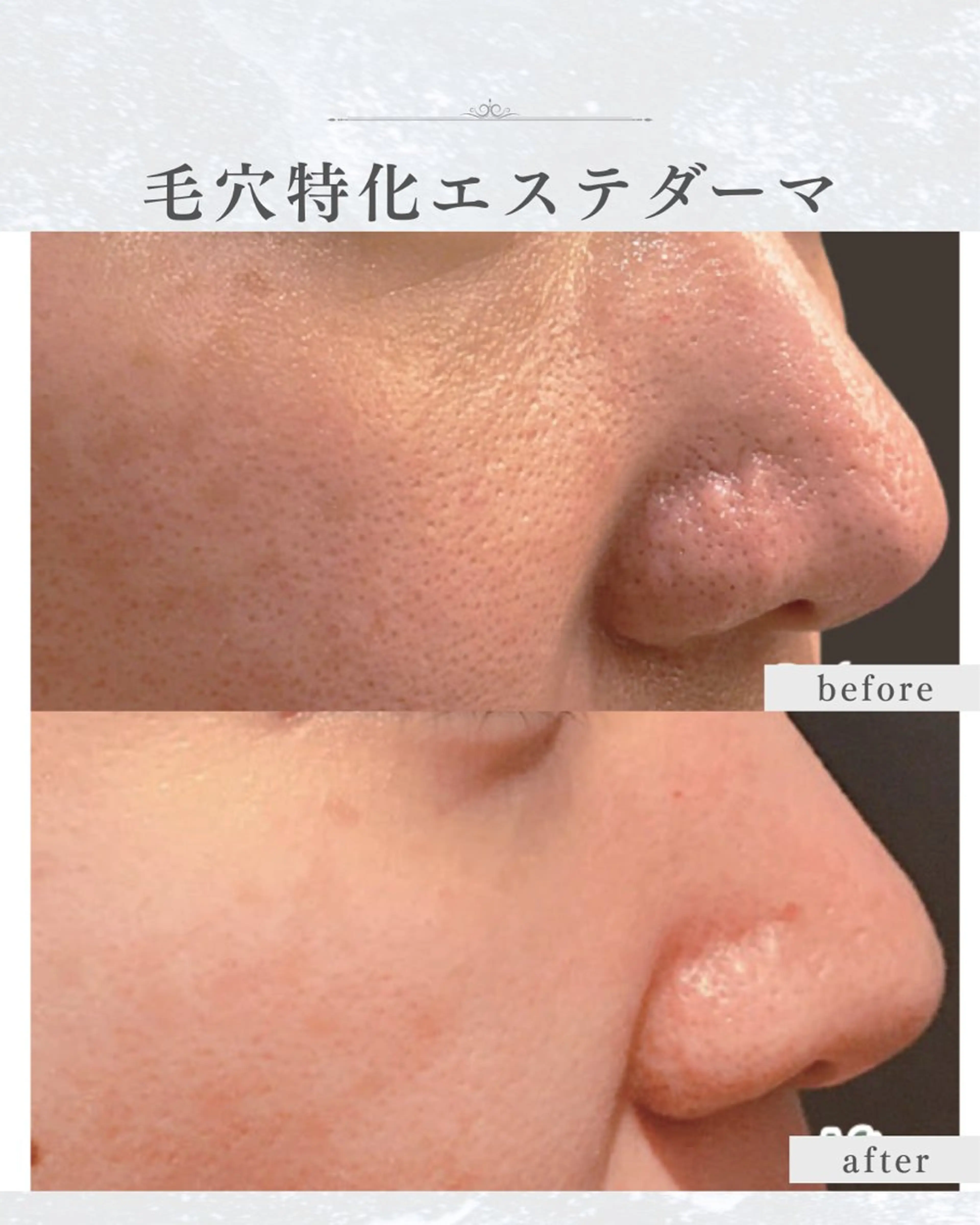 エステ シミ・毛穴ケア専門 クロヌYUKIのエステ・リラクイメージ