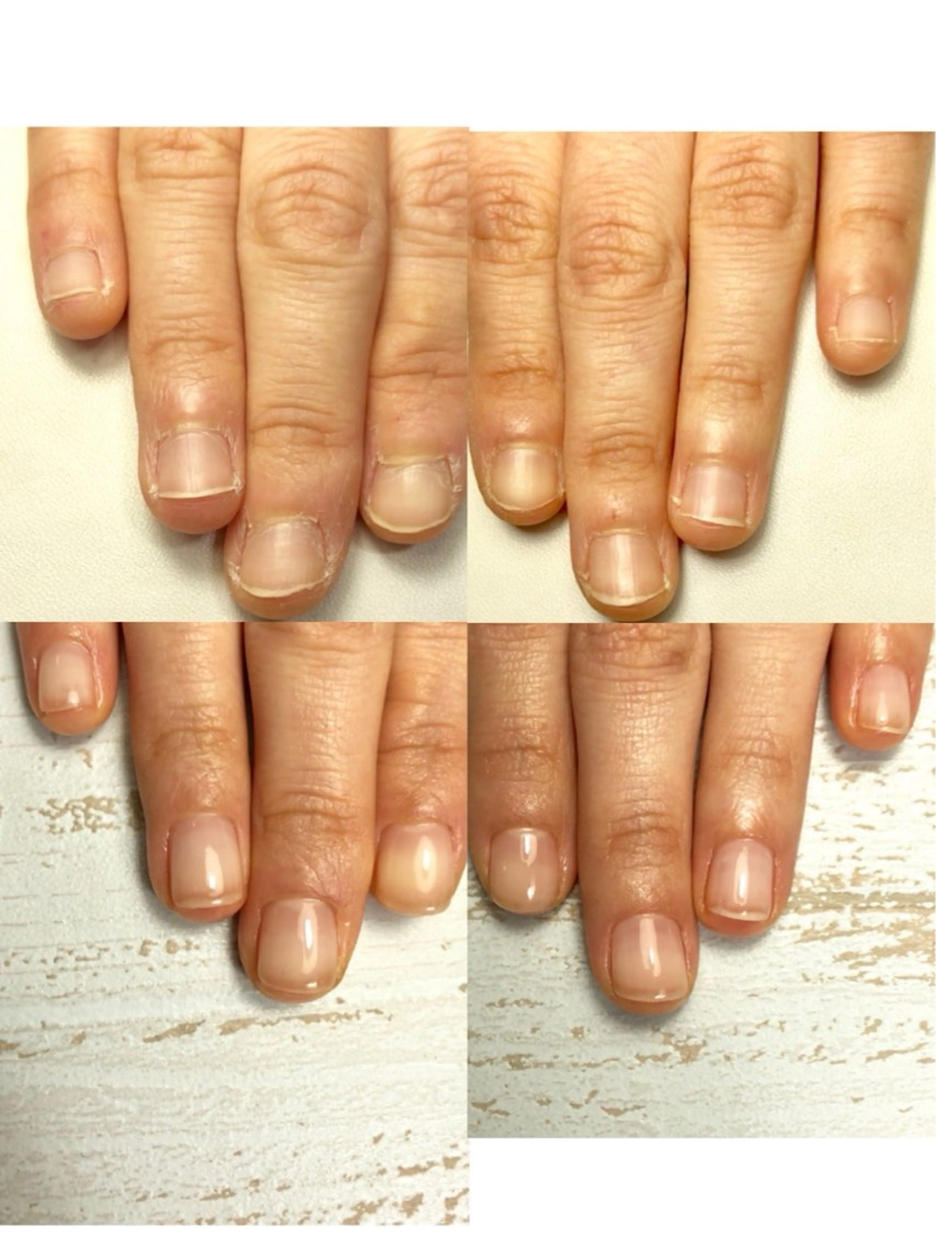 深爪・噛み爪改善モニター（5名限定）の写真