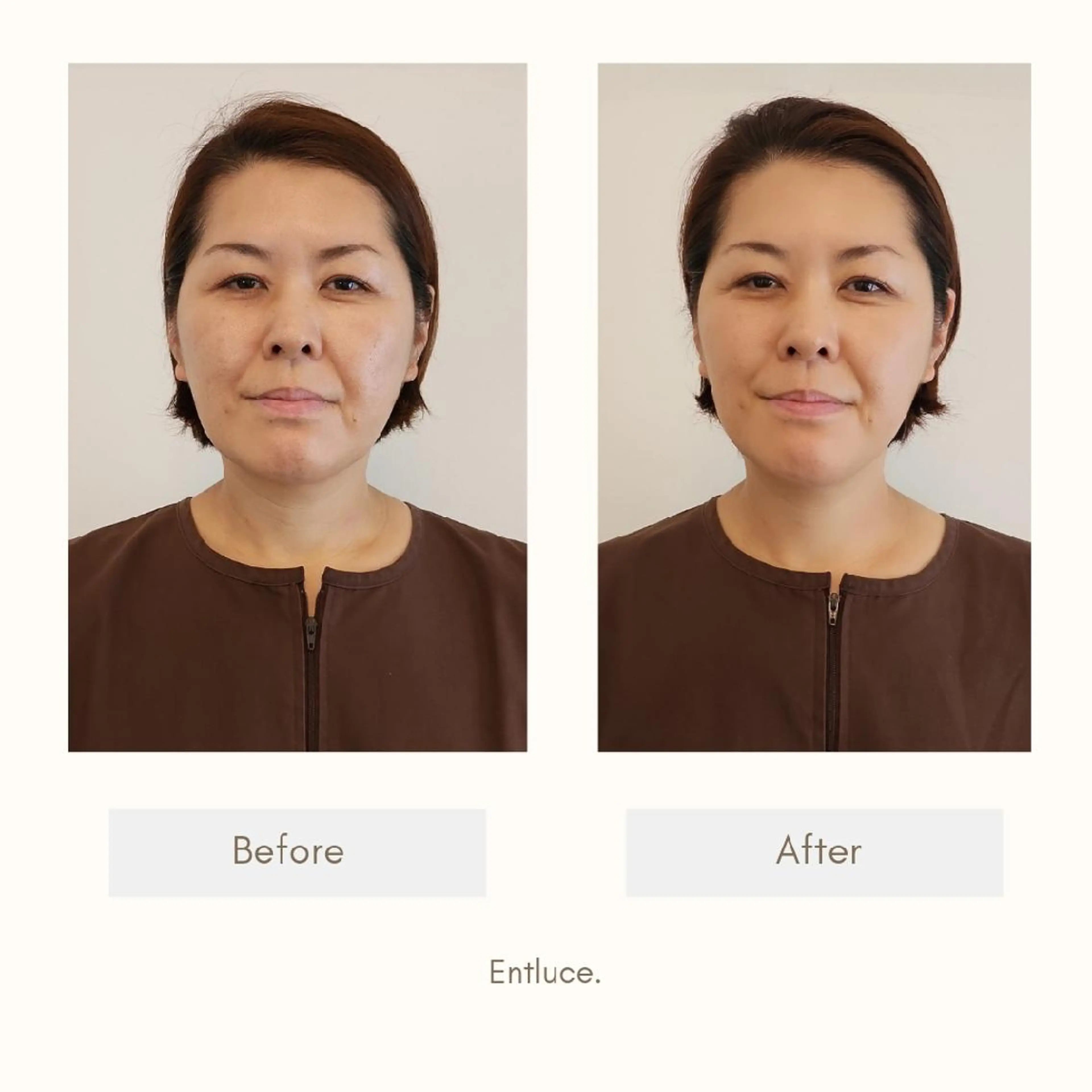 エステ リラク 即効⚡小顔美容鍼🪡 むくみたるみ脂肪解消のエステ・リラクイメージ