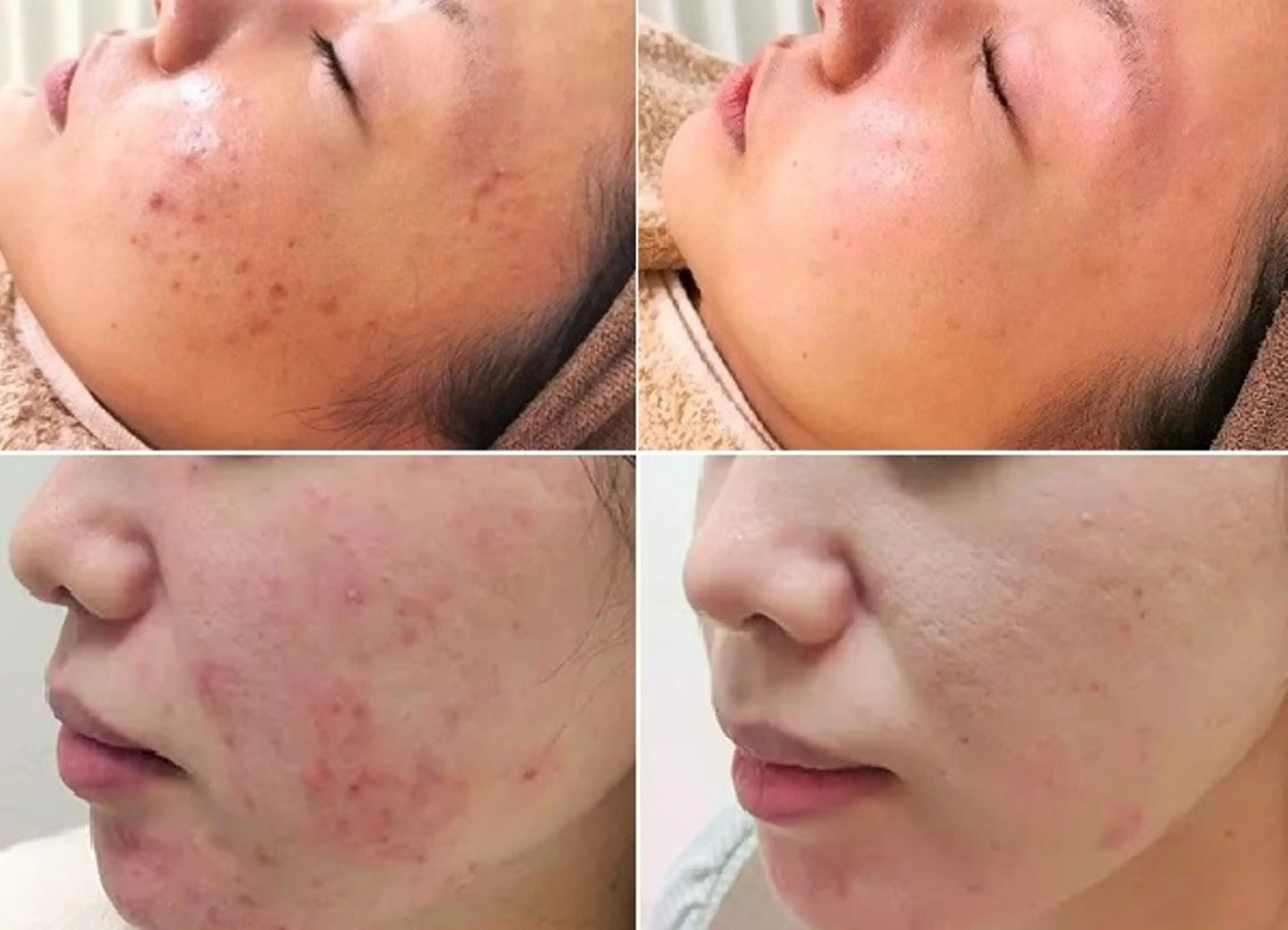 【ニキビ集中ケア】Ｗフェイシャルでニキビ徹底ケア＆肌修復で毛穴レスな美肌♪2回目以降はIPL光美容を全回数無料の写真