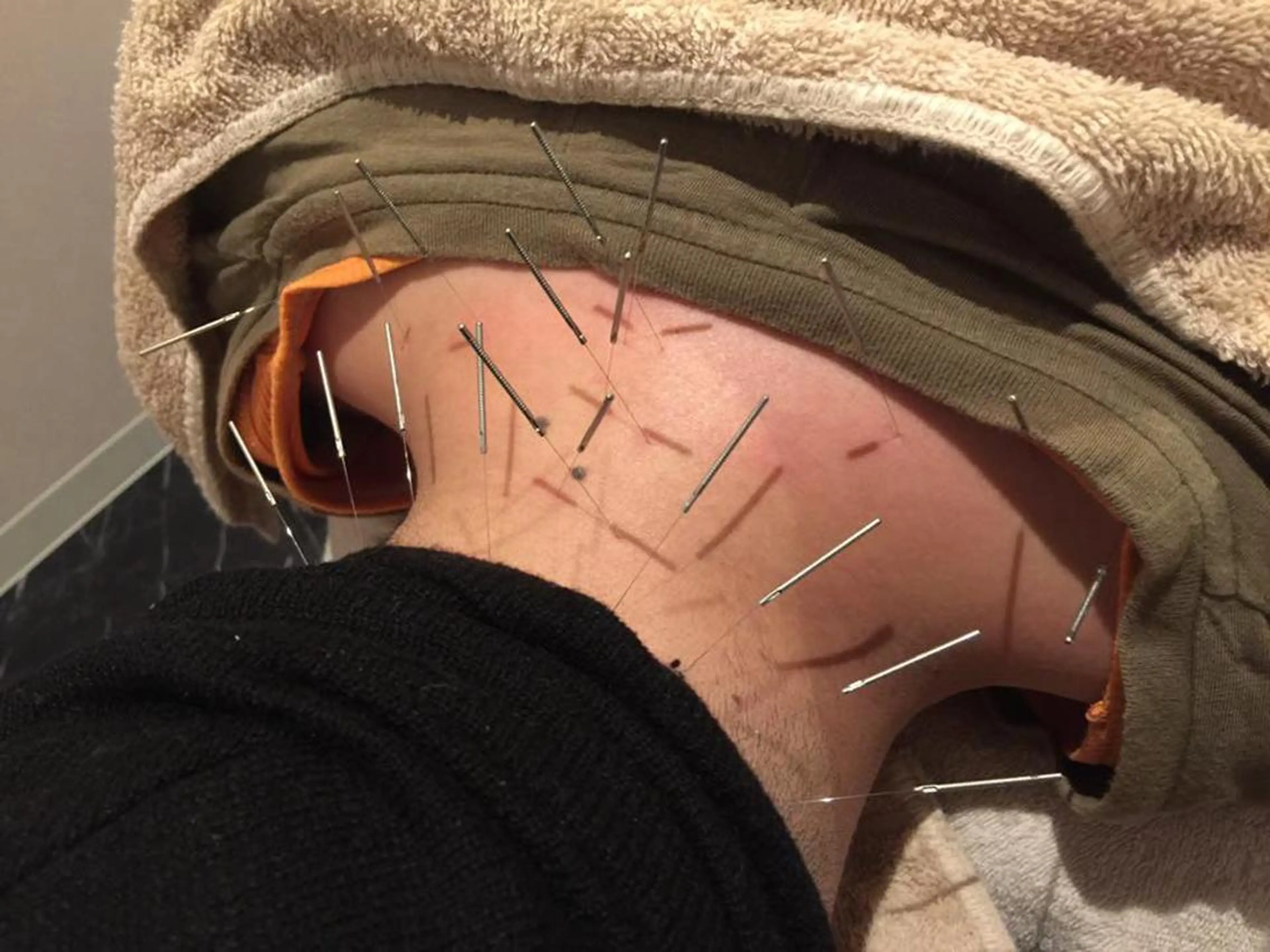 エステ 西通り鍼灸整骨院 小顔矯正•美容鍼のエステ・リラクイメージ