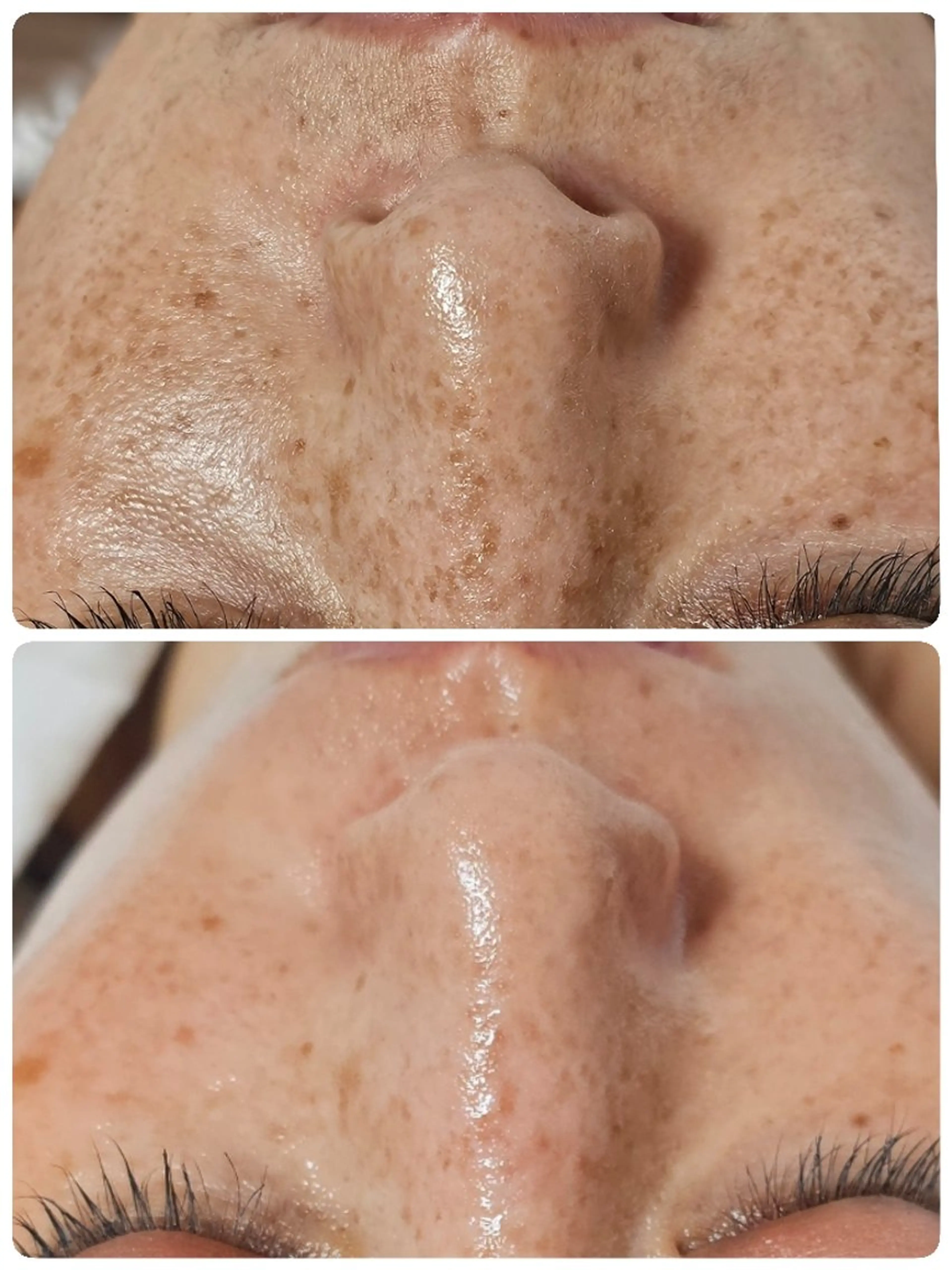 光フェイシャル『シミ▪️シワ▪️くすみ ケア』✩.*˚の写真