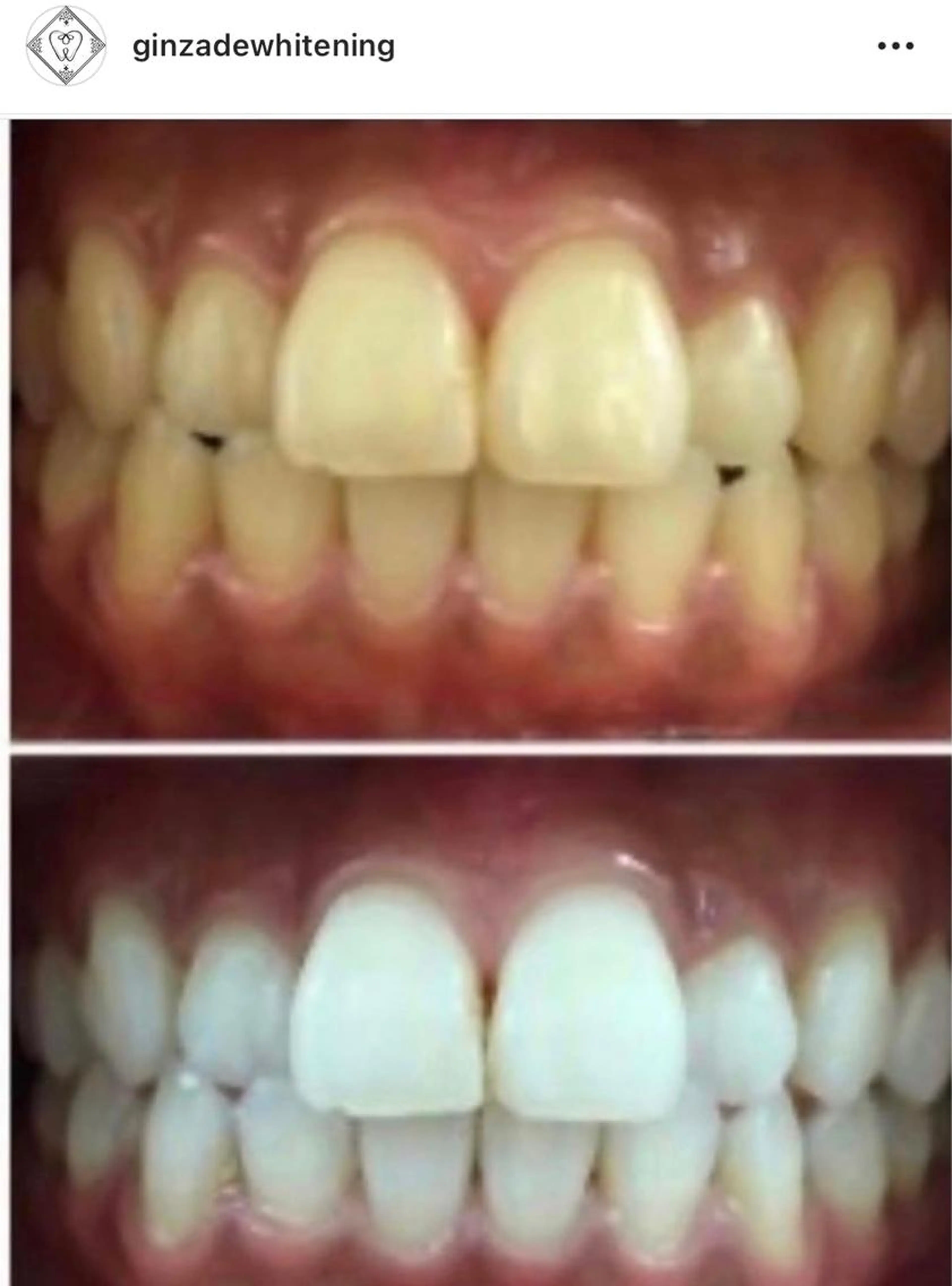 【通い放題プラン】効果No.1、納得する白さまで目指そう！セルフホワイトニングやり放題✨の写真