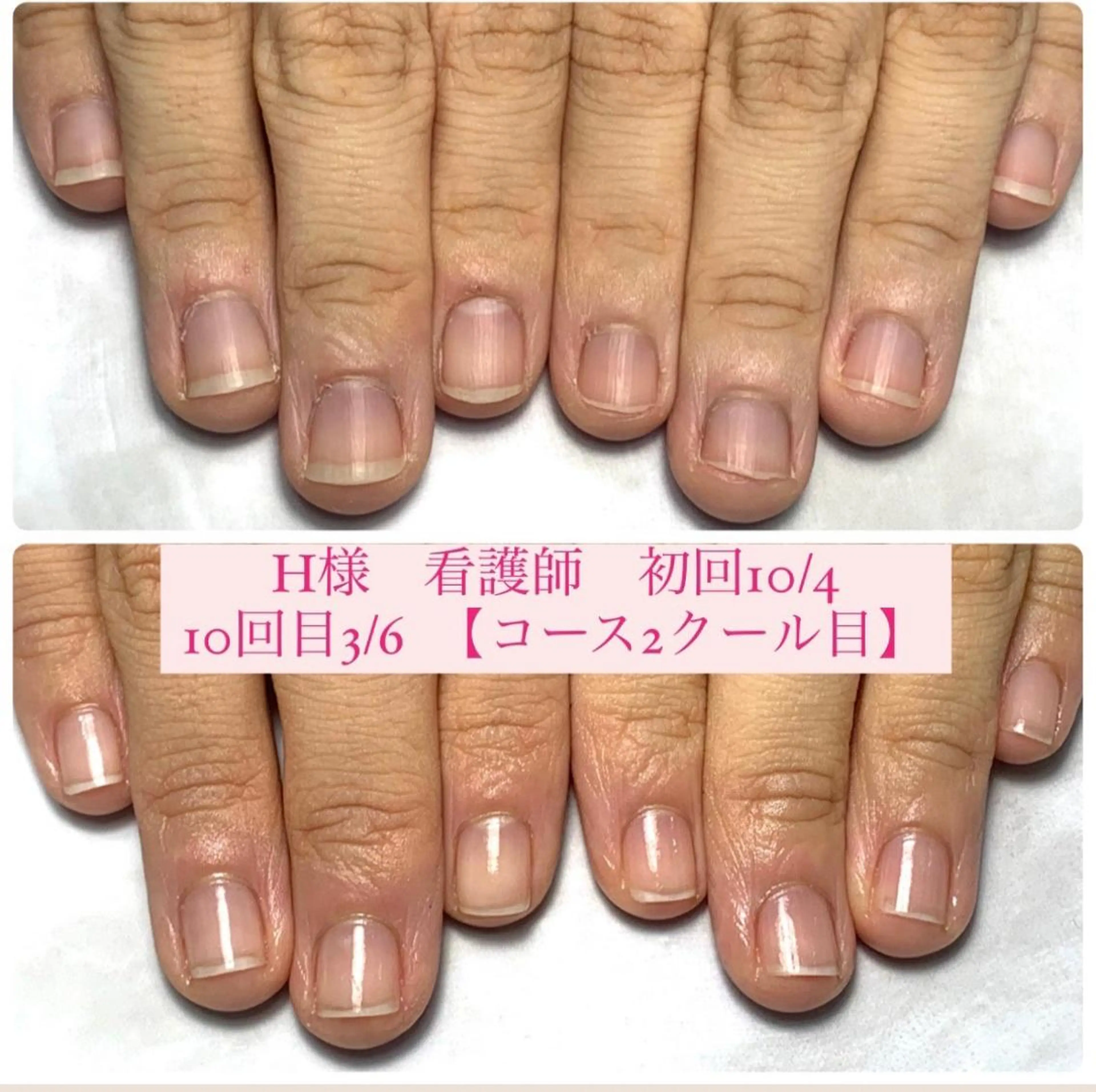 ネイル 自爪育成/深爪矯正 mikiのネイルデザイン