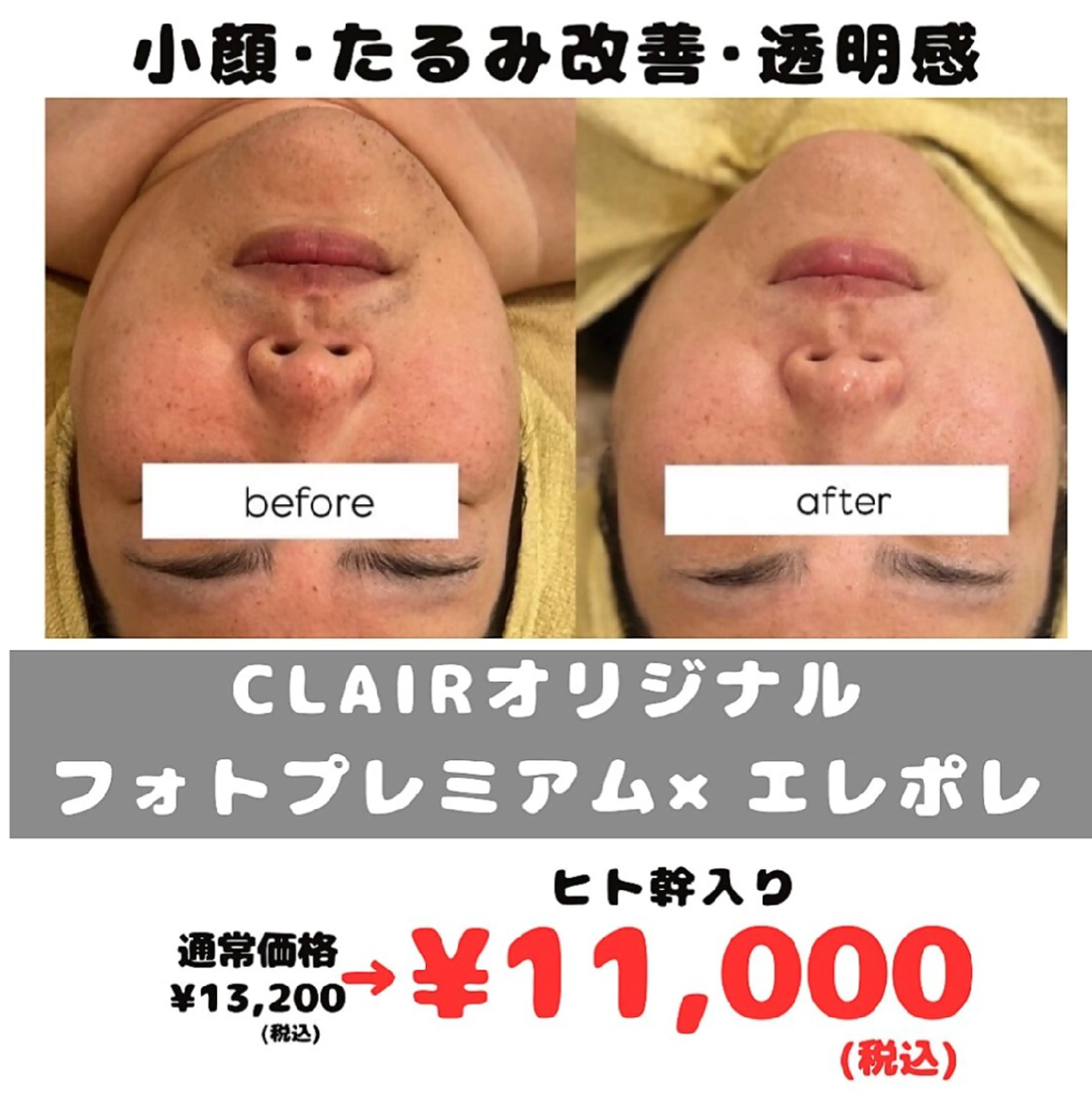 【人気No.1】美肌フォト×美容液導入¥13,200→¥11,000【たるみ改善コース】の写真