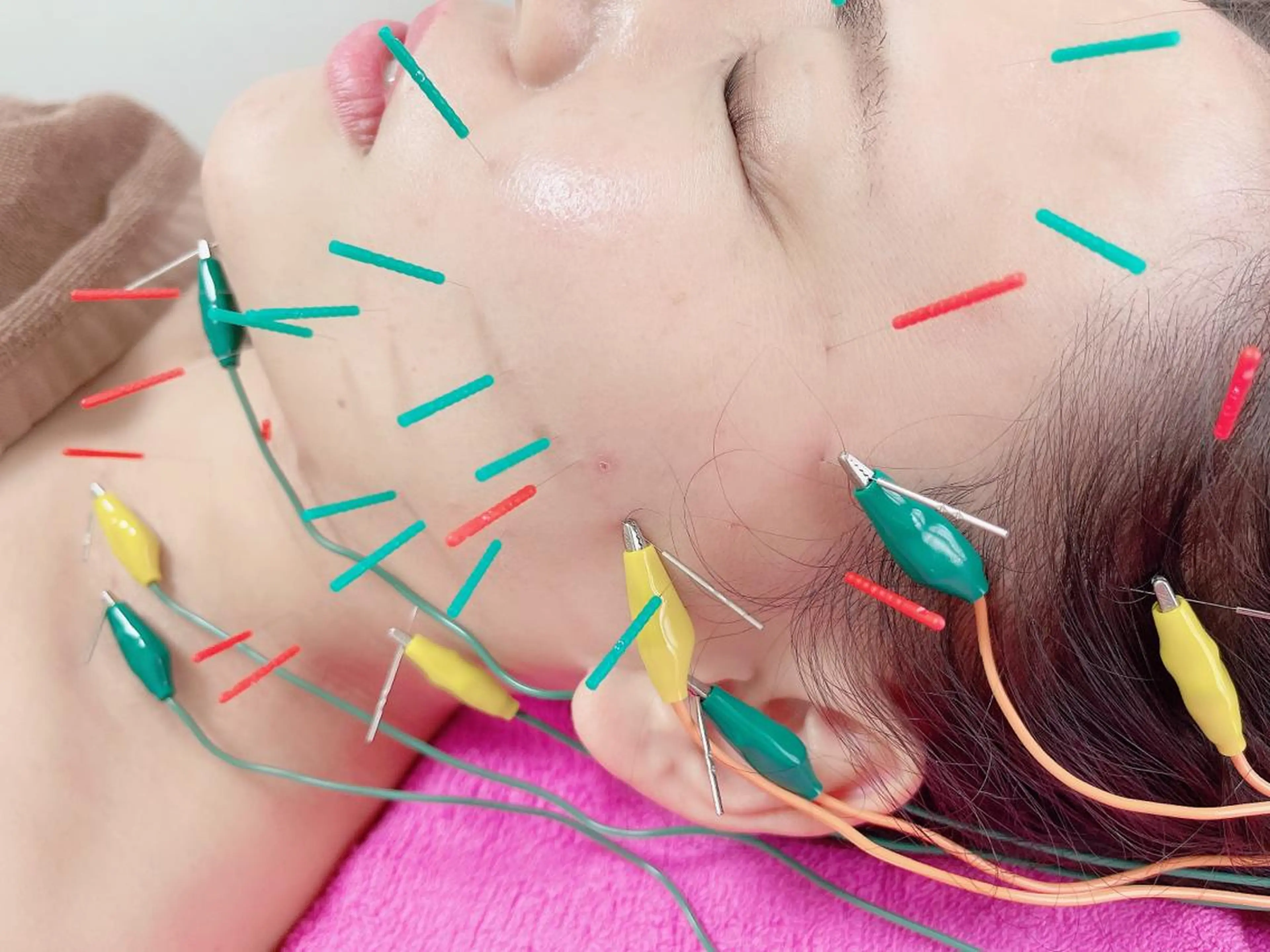【最短30日で小顔を目指す✨️】エラの張り/食いしばりの悩みに美容鍼30本 8回セット80,000円相当⇒60,000円の写真
