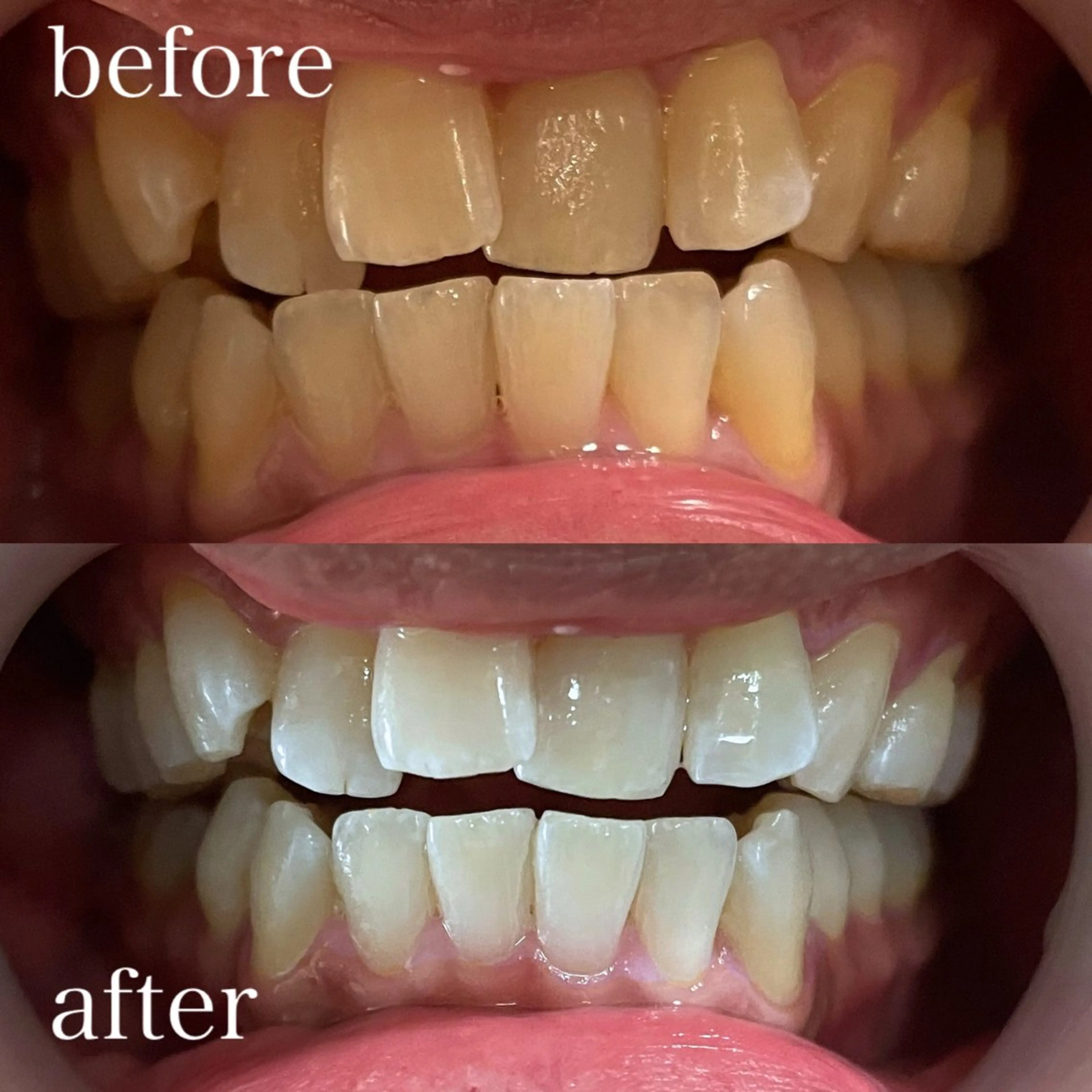 🦷🔰まずはお試し🔰🦷ナチュラルホワイトニング✨【通常¥9900→初回¥3600❤️‍🔥】今だけ価格！の写真