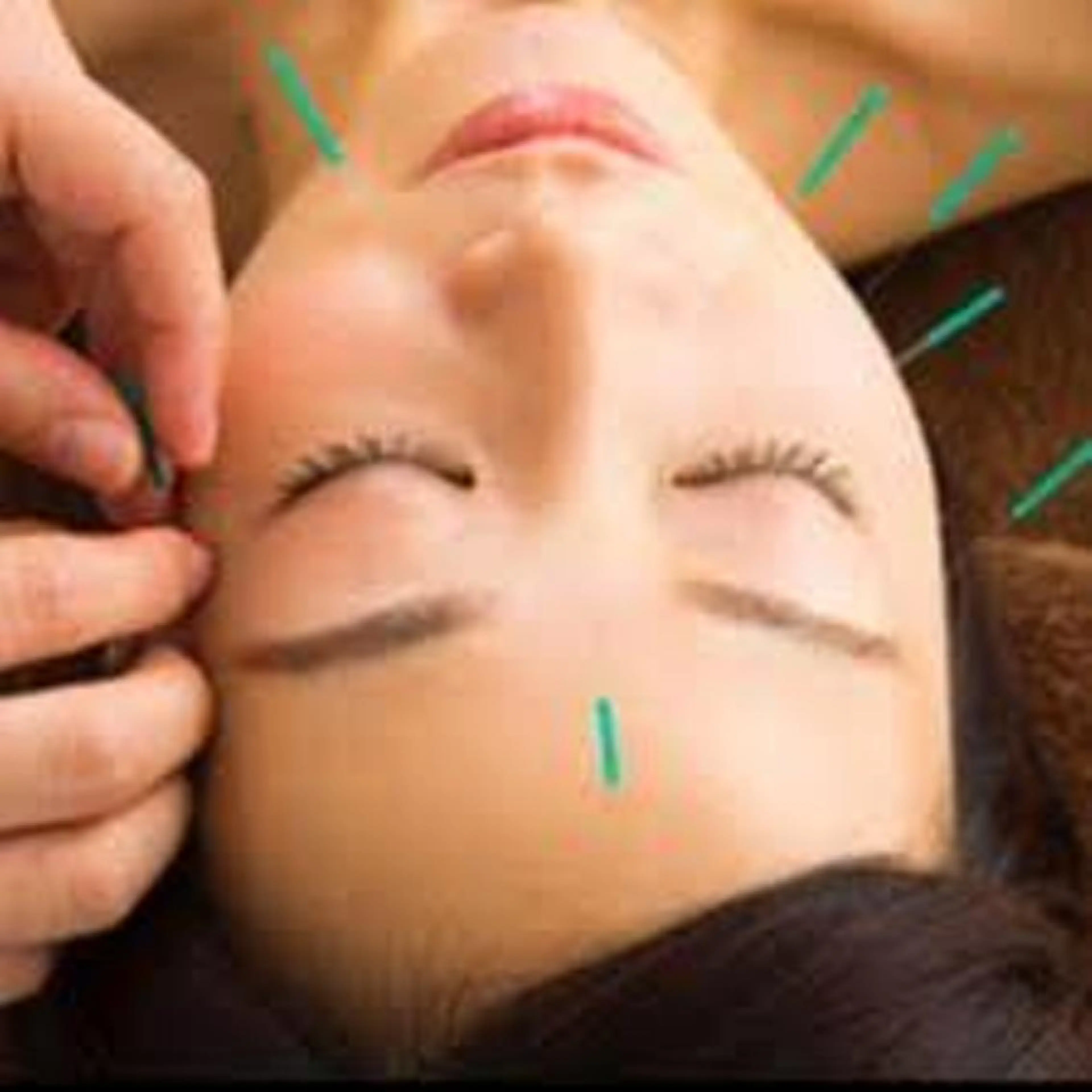 ⭐️ミニモ限定⭐️美容鍼セットコース（美容鍼＋小顔フェイシャル)⭐️5,500円❗️（通常価格より2550円引き）の写真