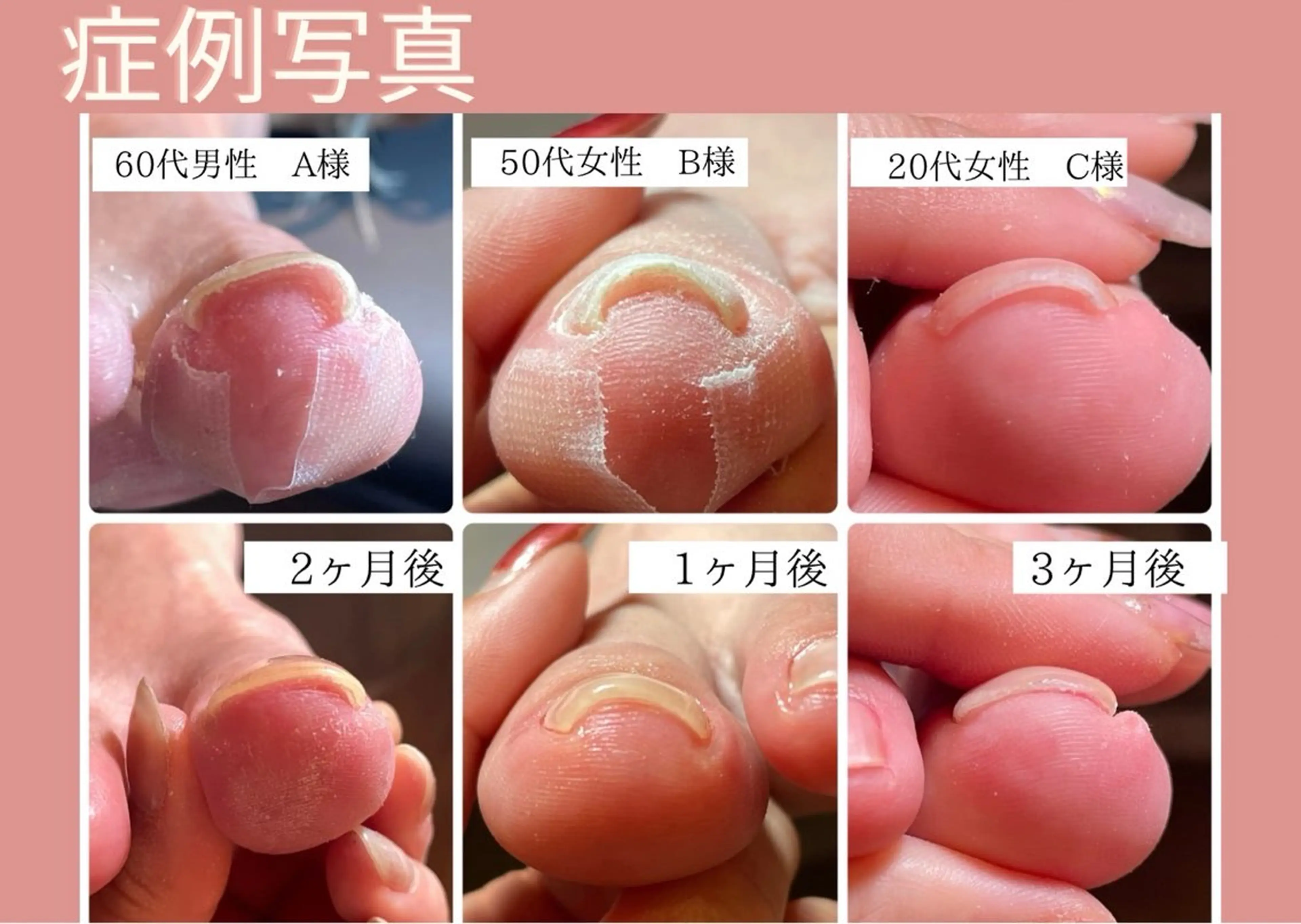 ヘイスイッチ【巻き爪ケア】の写真