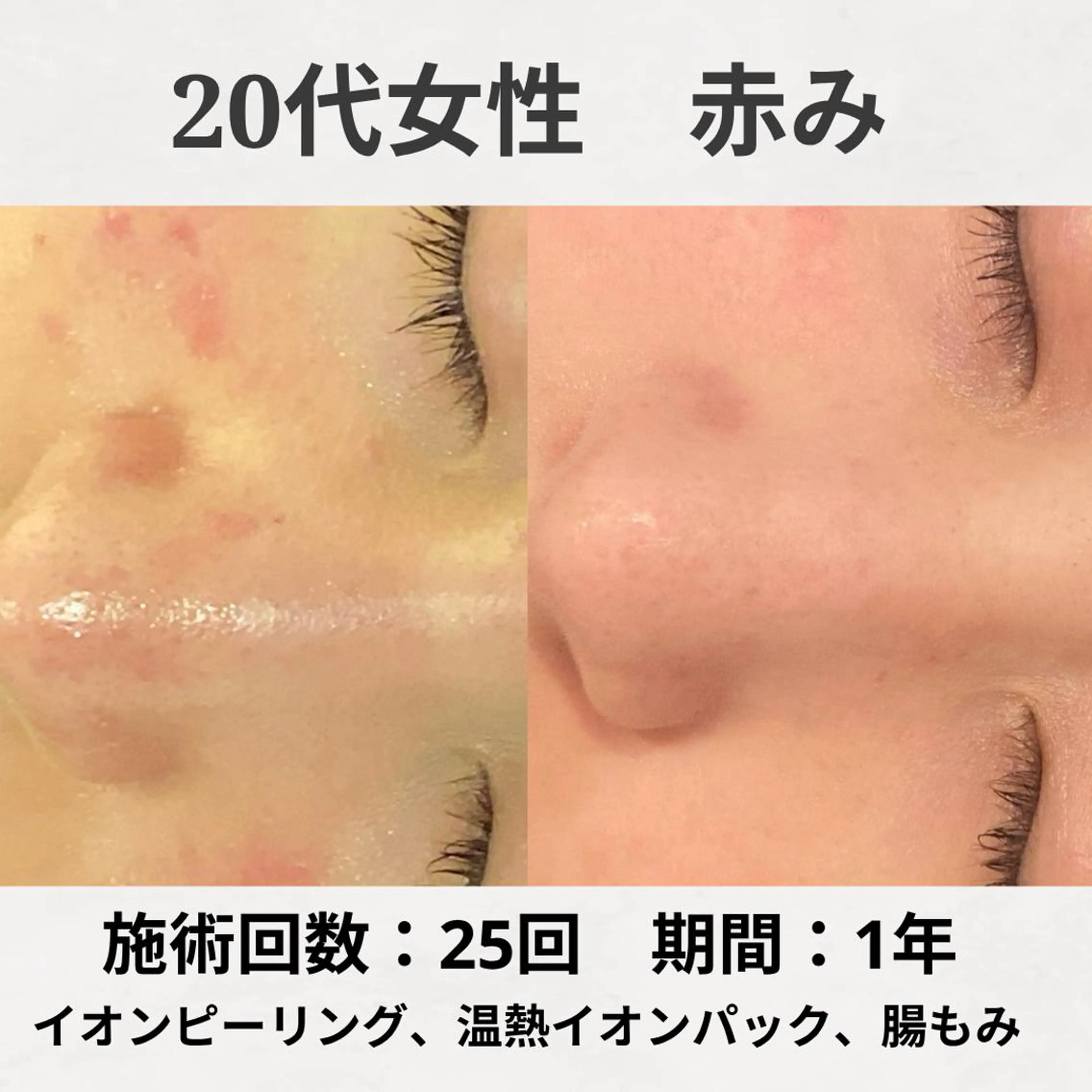 エステ リラク ニキビ跡改善専門🔥 医療にはできない改善のエステ・リラクイメージ