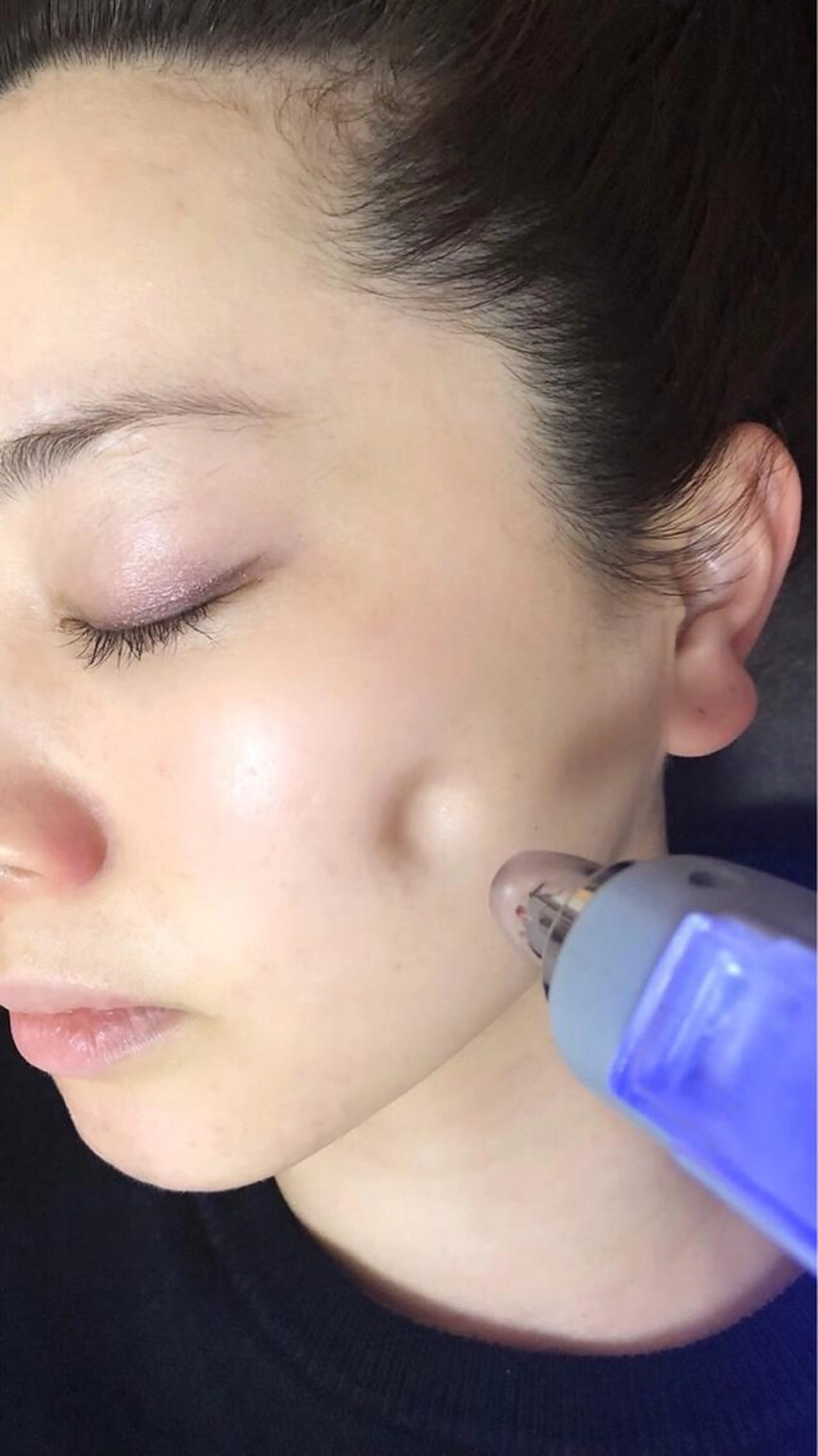 話題の針を使わない美肌水光フェイシャル✨水で弾いたような輝く美肌に💓の写真