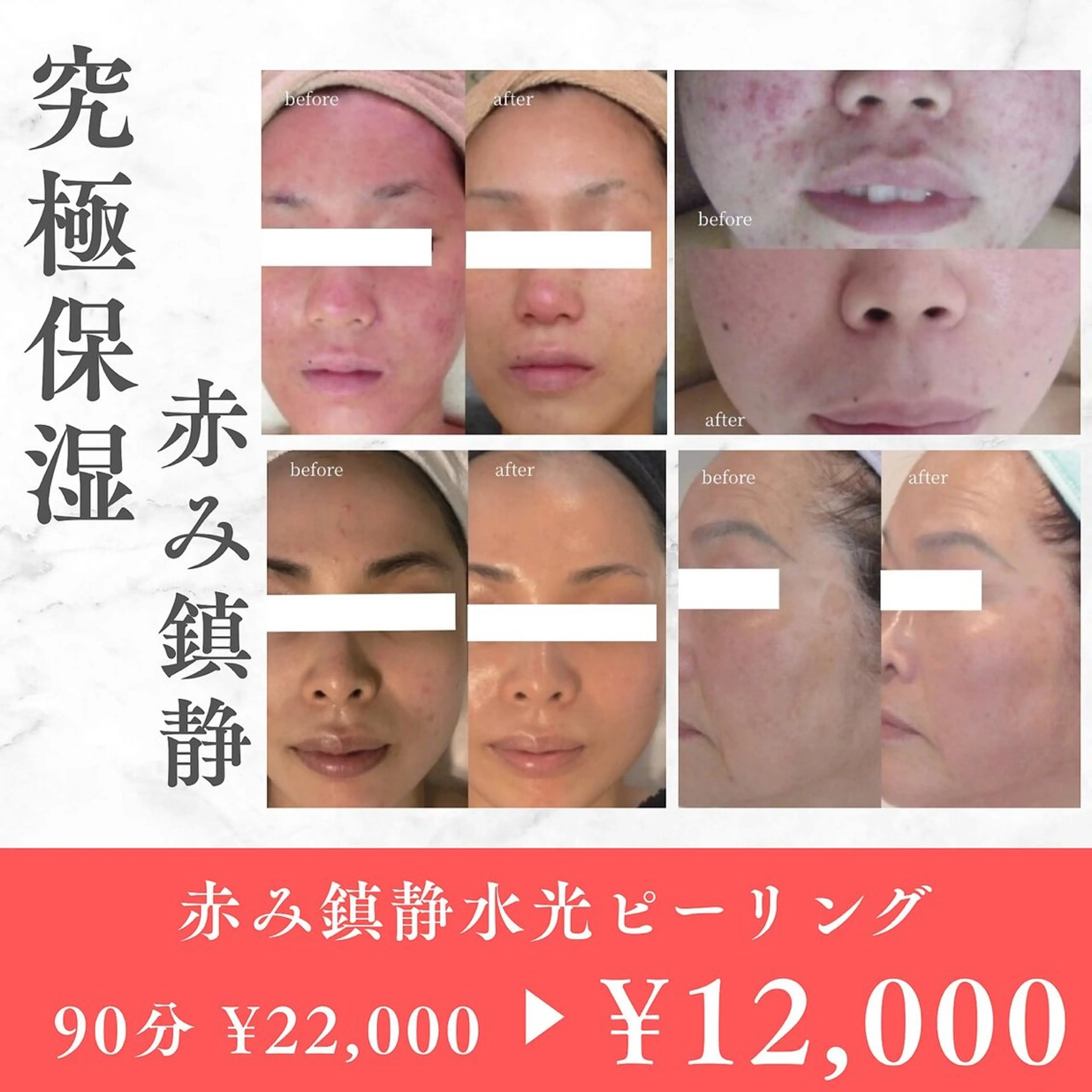 【保湿・赤み鎮静】赤み改善鎮静水光ピーリング　¥22,000→¥12,000の写真