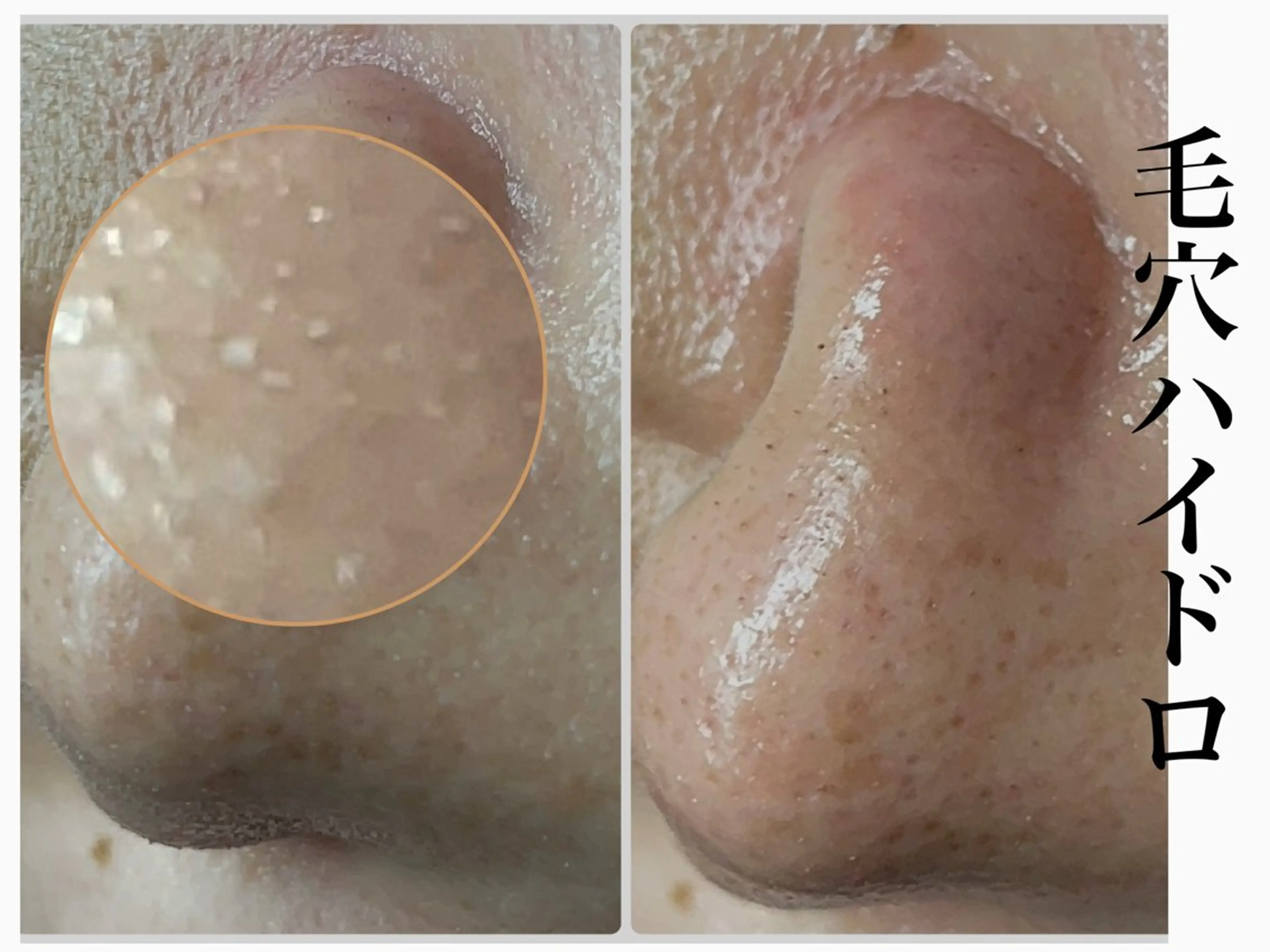 エステ Chalon所属・REVI取扱・肌悩み 毛穴Chalonのエステ・リラクイメージ