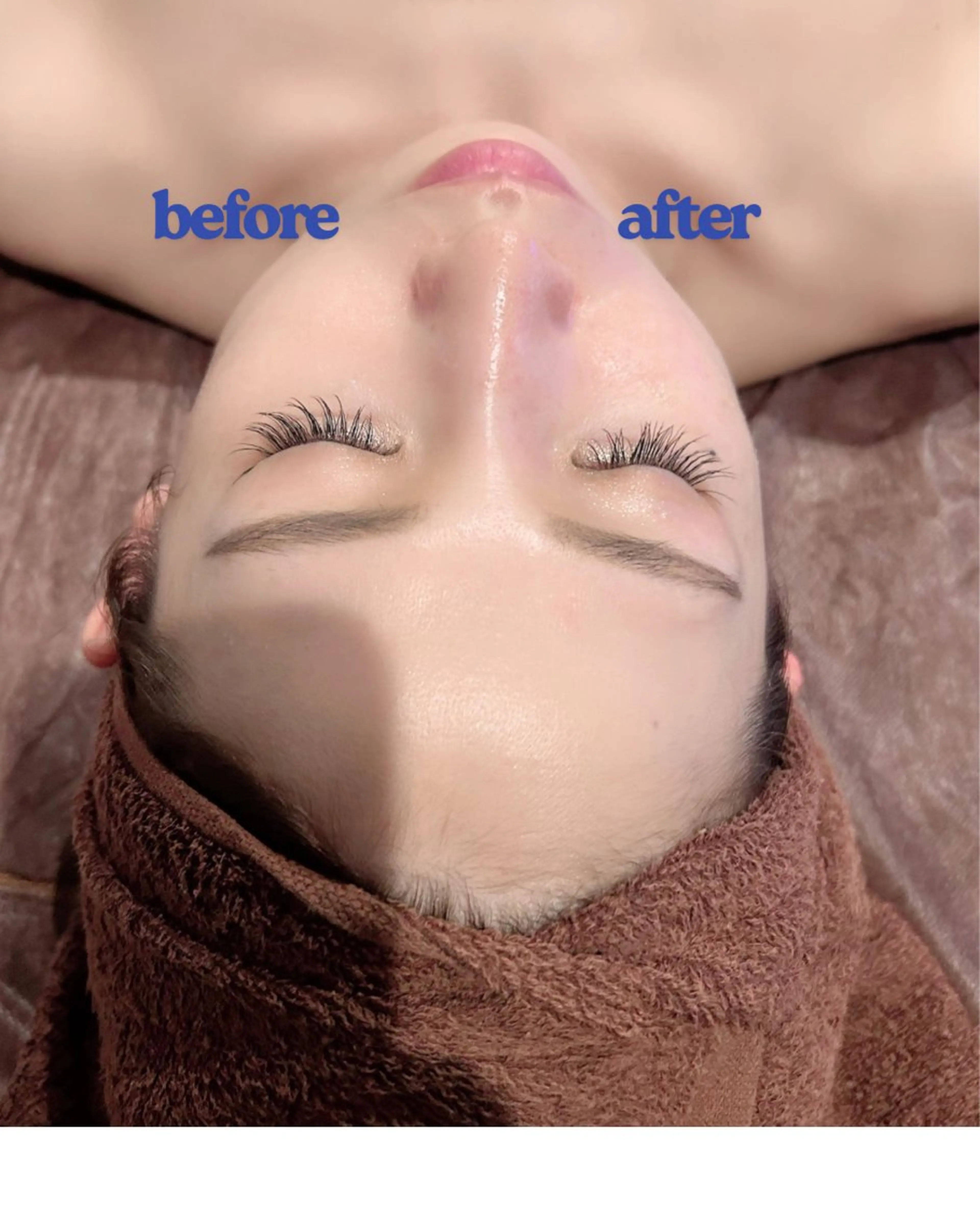 エステサロンで出来る次世代糸リフト🧖‍♀️顔の引き上げ・顎のたるみ施術後すぐに実感😳✨の写真