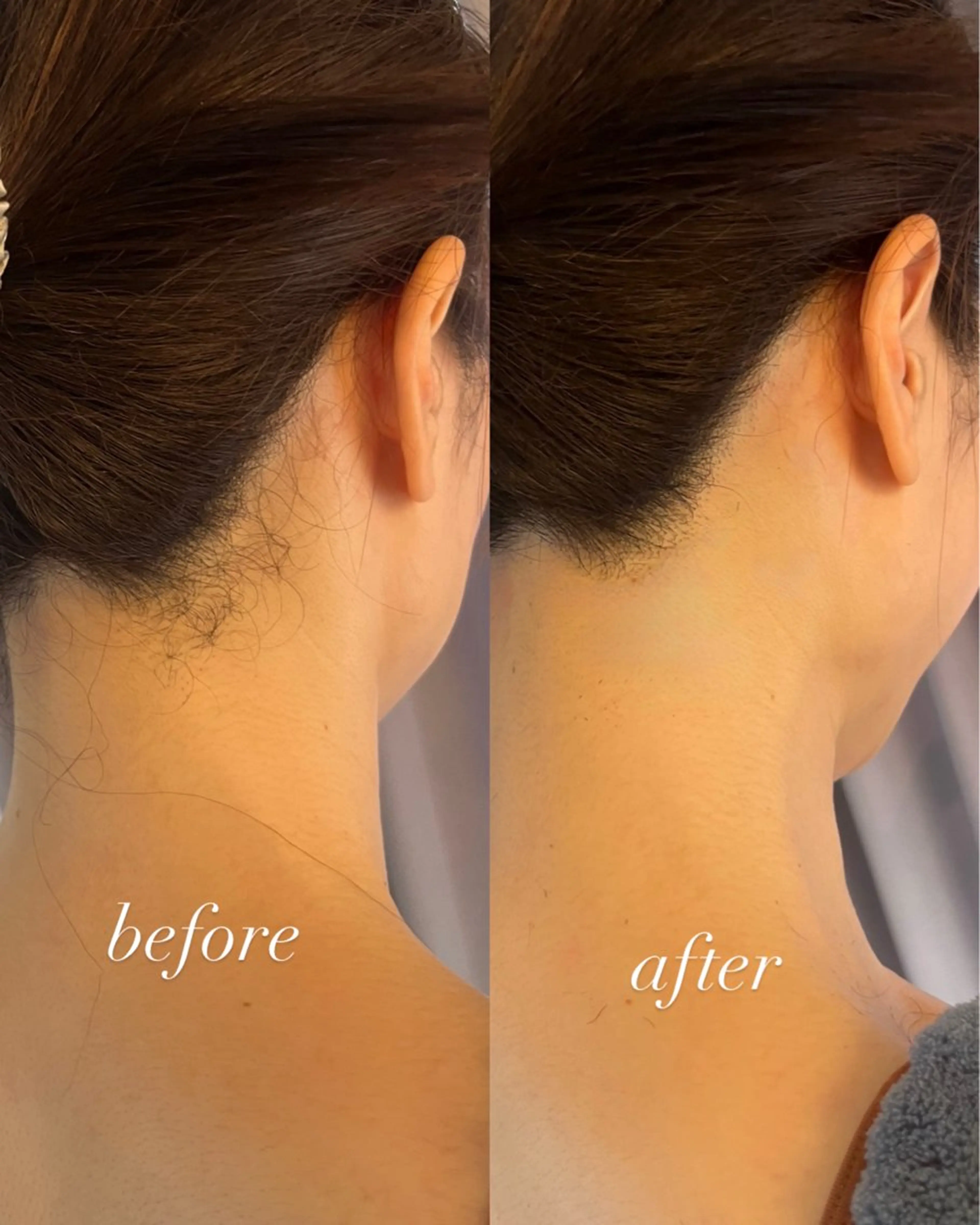 脱毛 うなじ脱毛/美肌脱毛 LABELのエステ・リラクイメージ