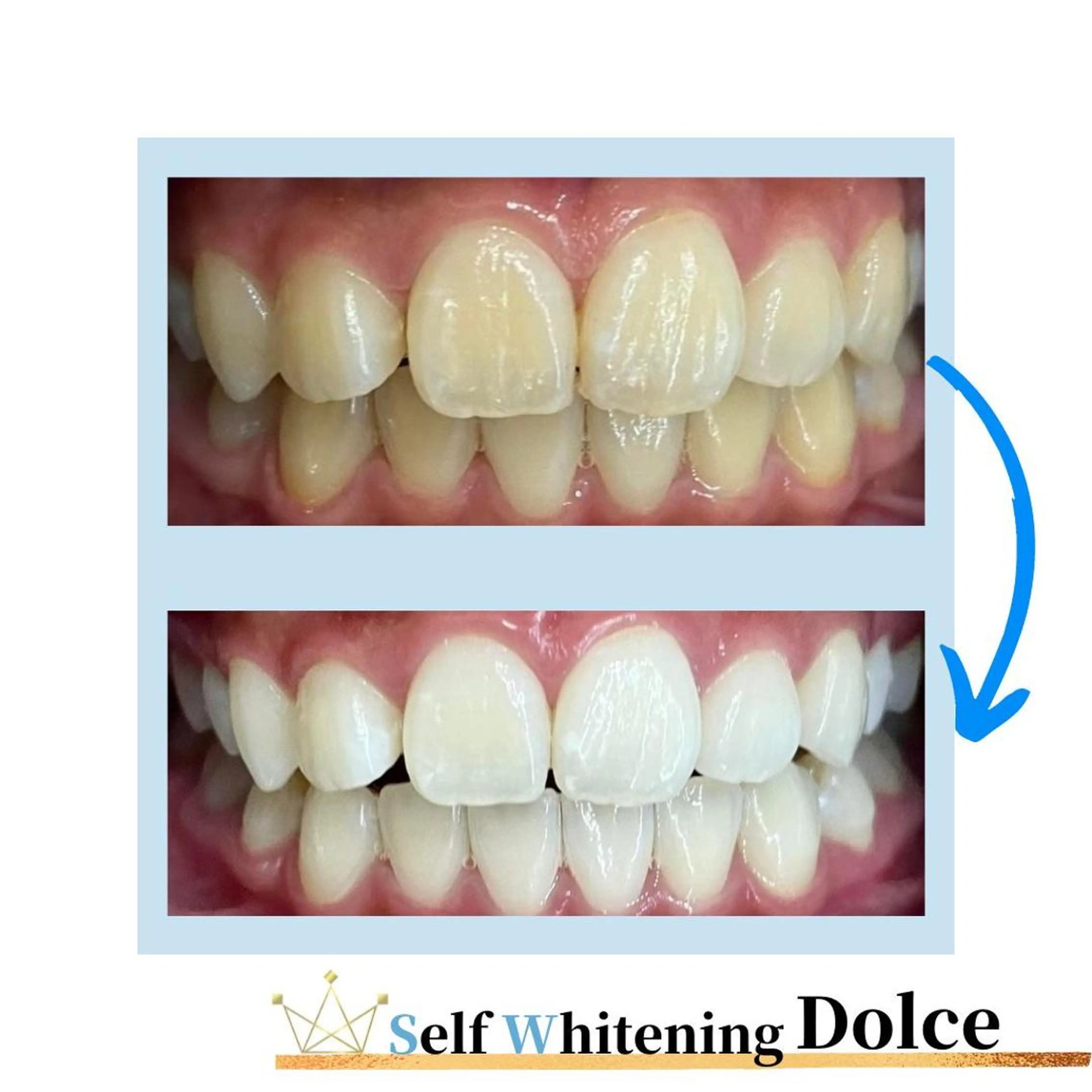 【再来】1ヶ月以内にプラチナムホワイトニングを施術した方限定❣️ホワイトニングは短期間集中が効果的🦷の写真