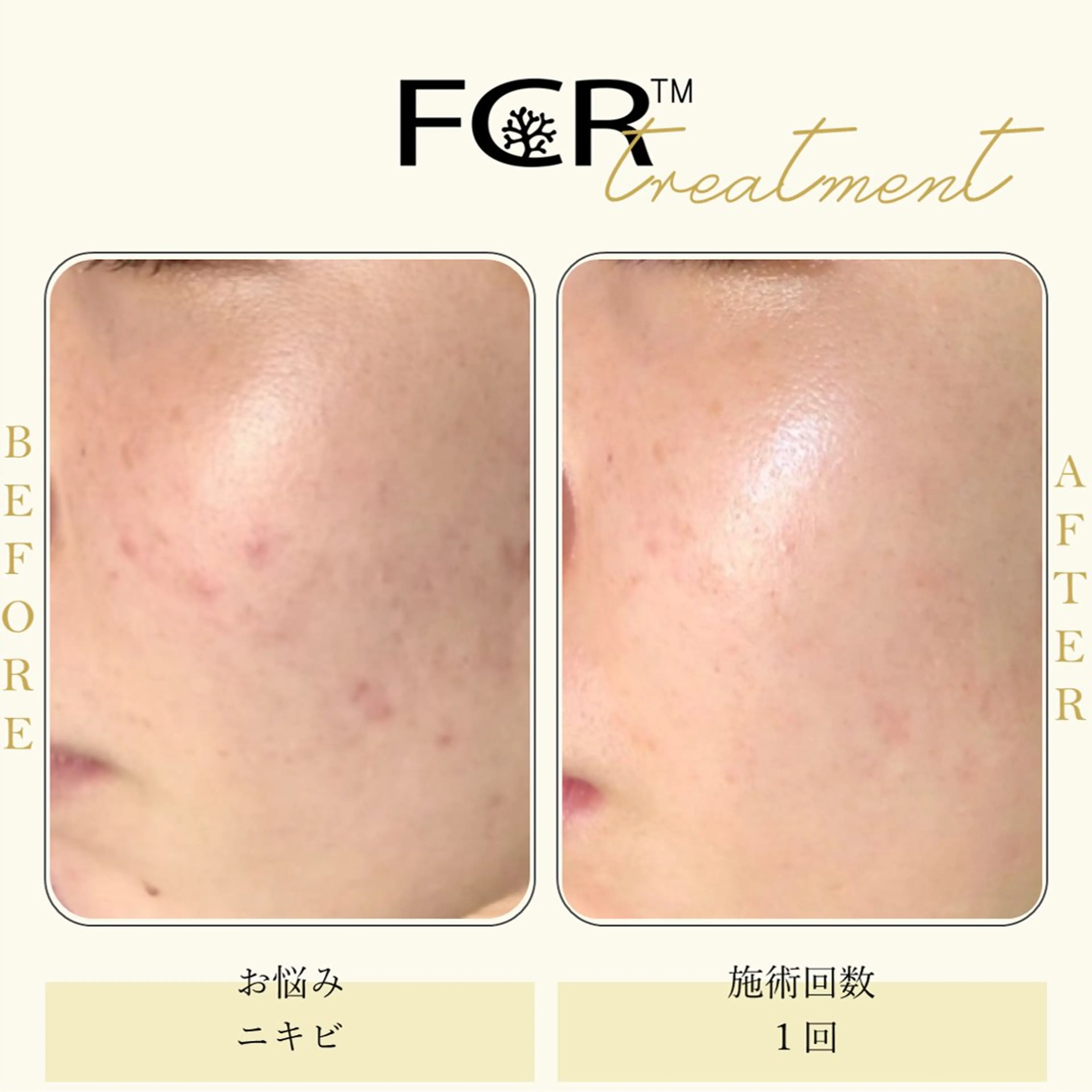 ニキビ 毛穴ケア シャルム ココ みさのエステ・リラクイメージ