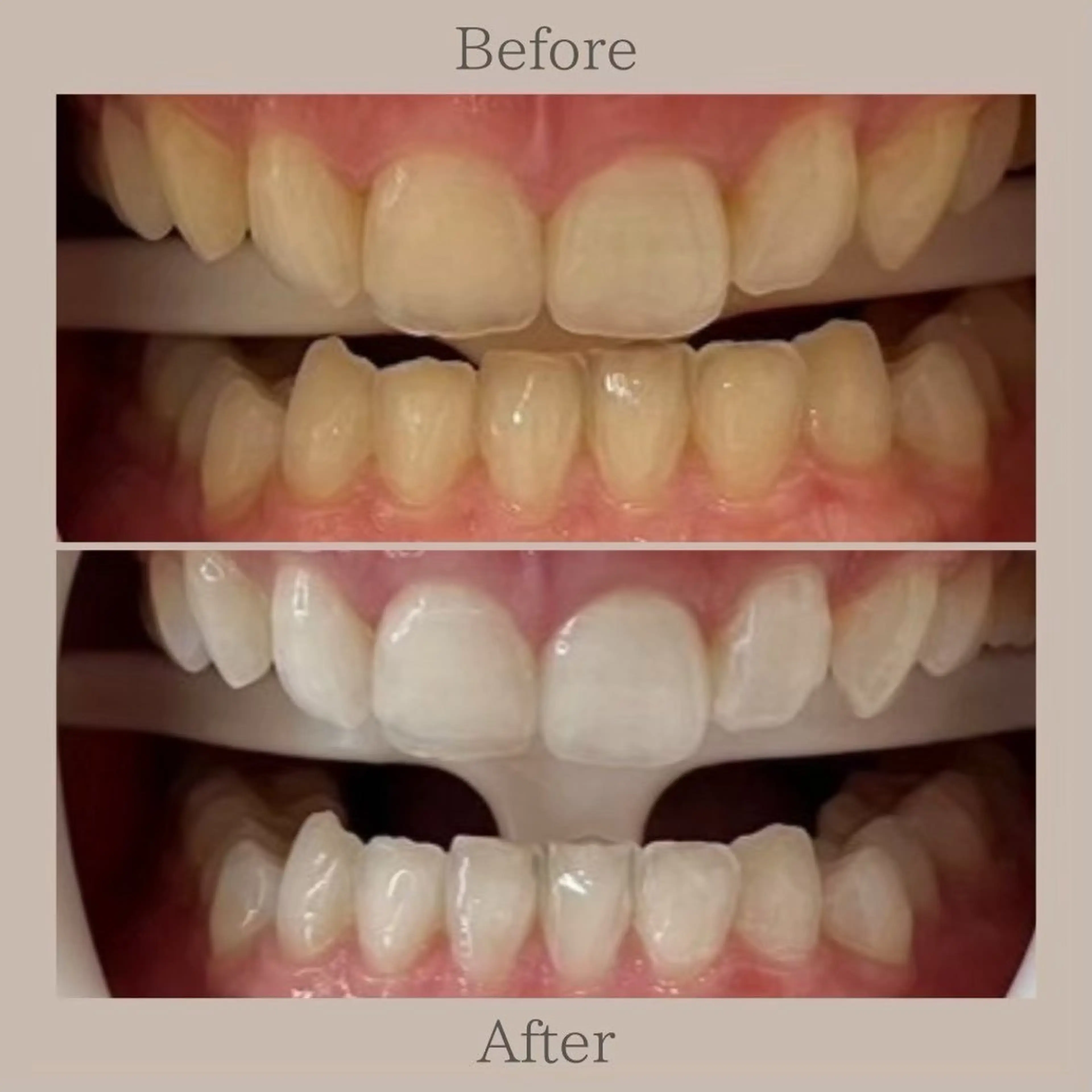 【再来】超音波セルフホワイトニング40分照射×1回🦷✨️　¥14,000→￥12,600の写真