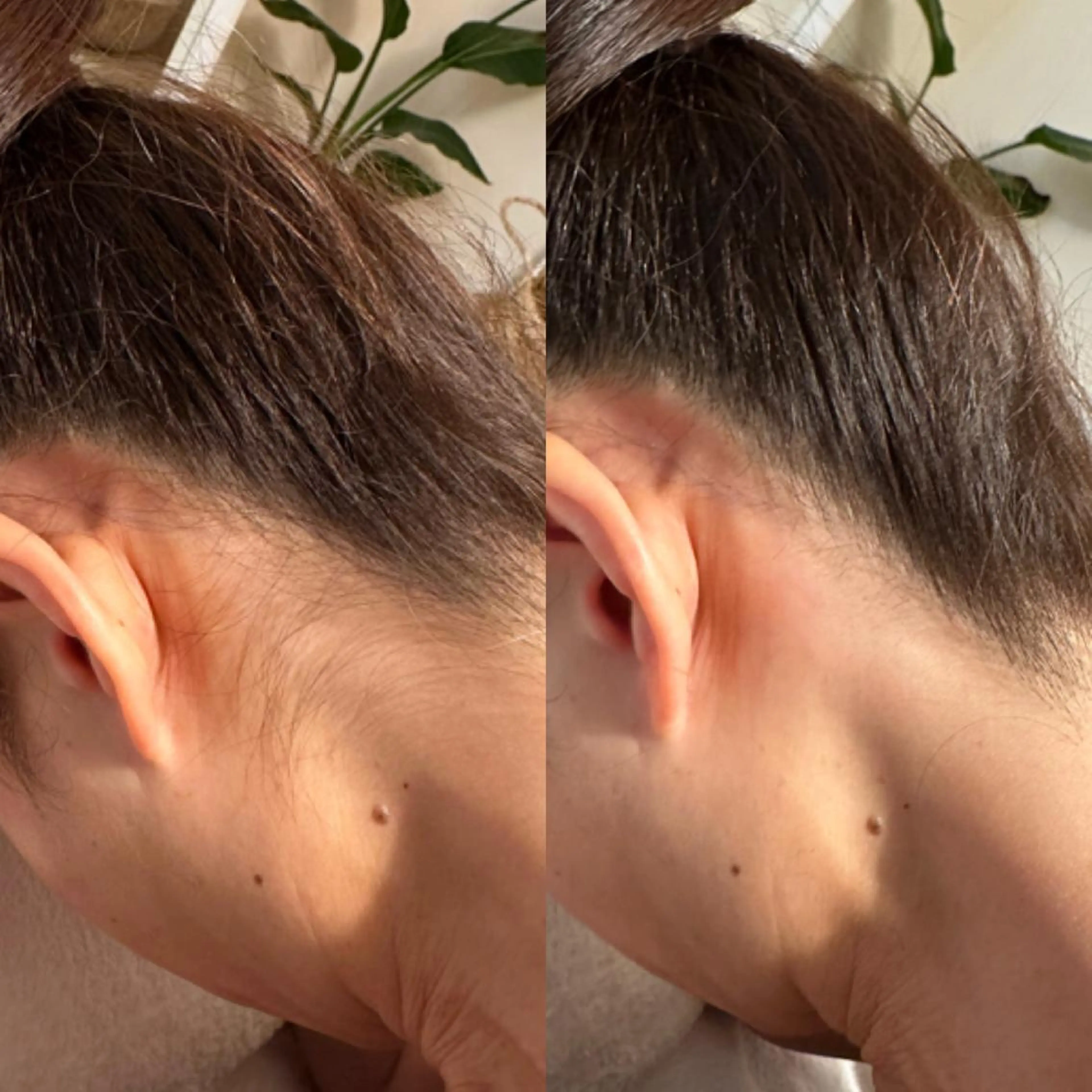 脱毛 Mパーツ【うなじ/両ひじ上/両ひじ下/腰】の写真