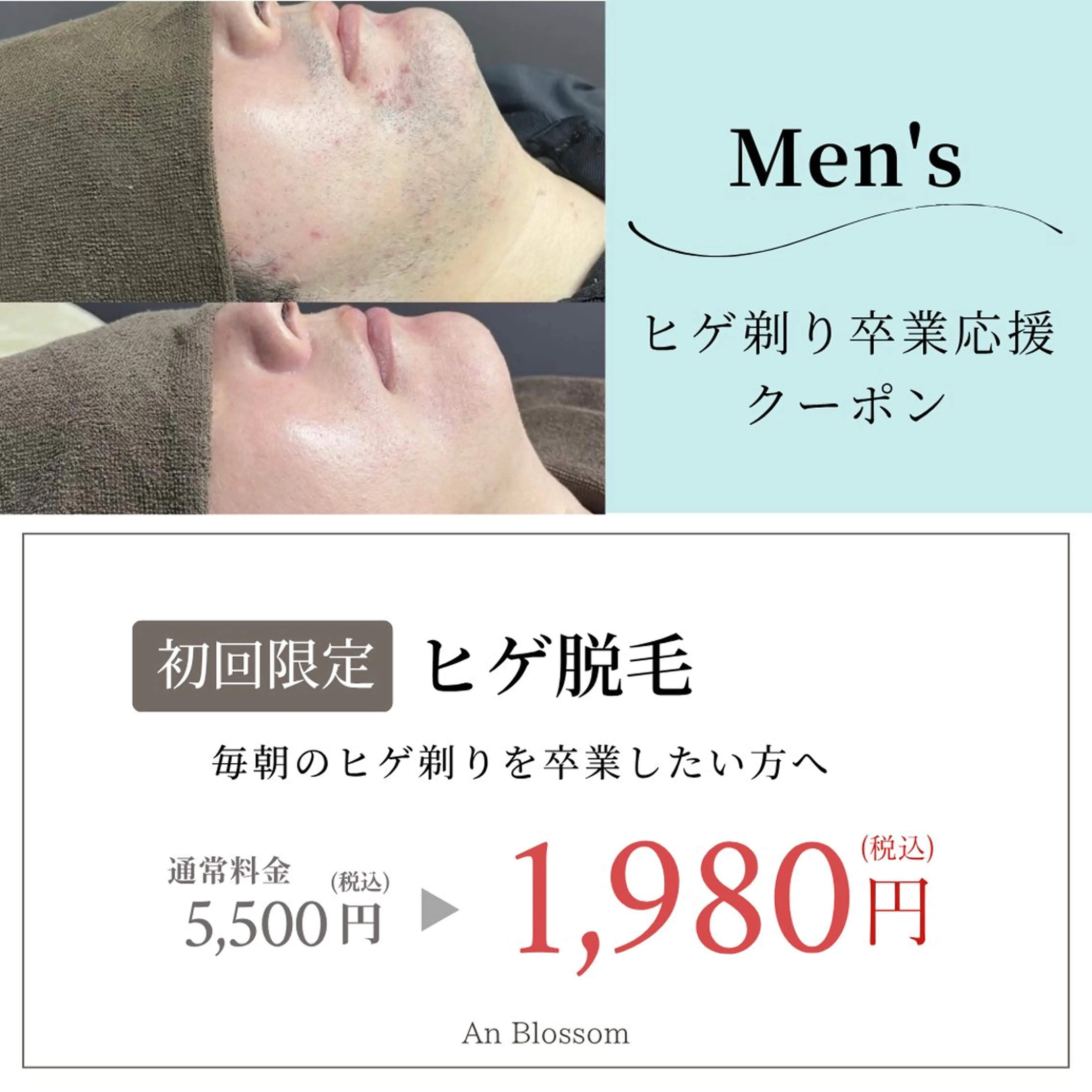 【初回4月限定🌸】👨‍💼メンズヒゲ脱毛✨清潔感upの写真