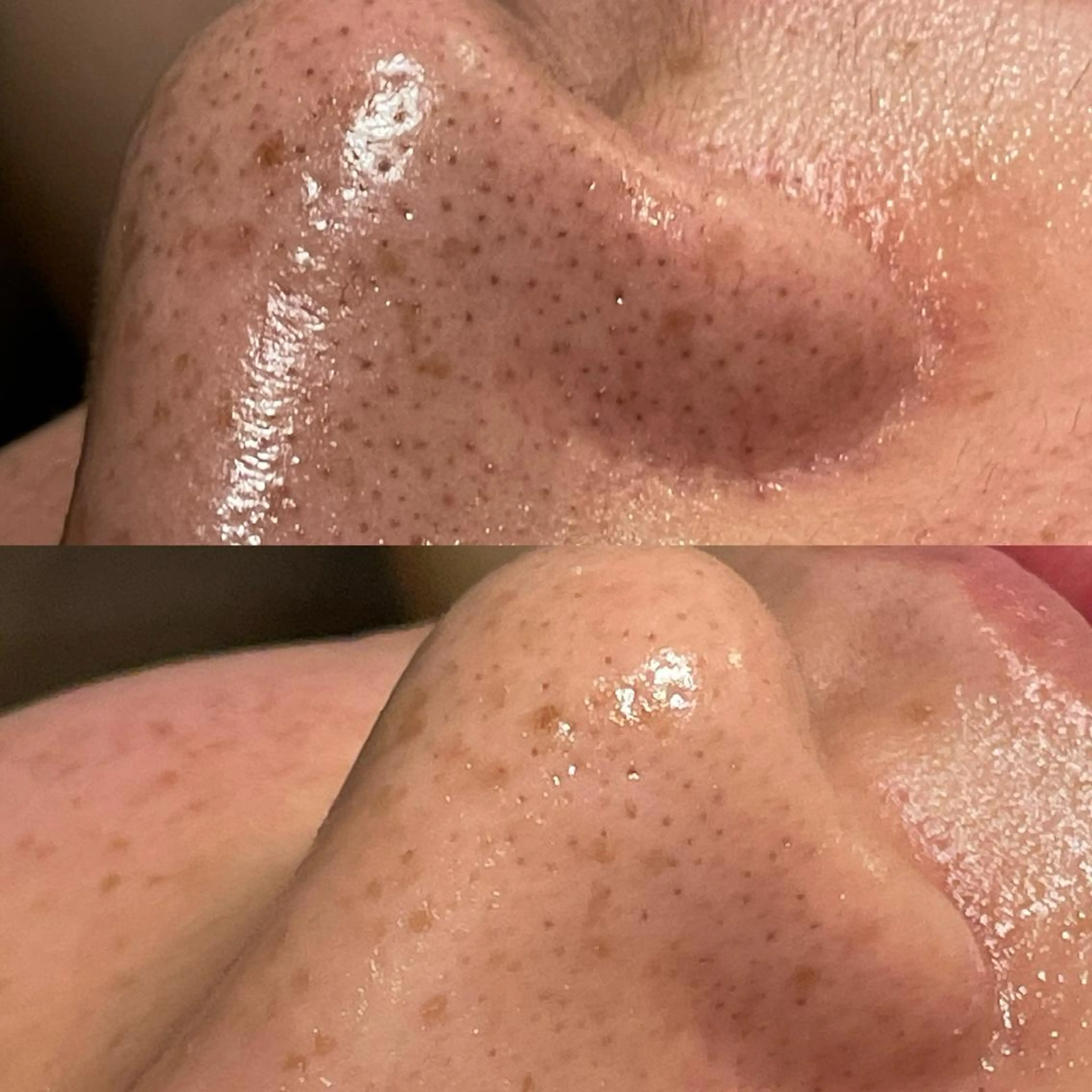 鼻の毛穴徹底大掃除🧹ハイドラAHAピーリング液塗布して角栓や毛穴詰まりをゆるゆるにしてから、さぁ！バキューム吸引✨水素の写真