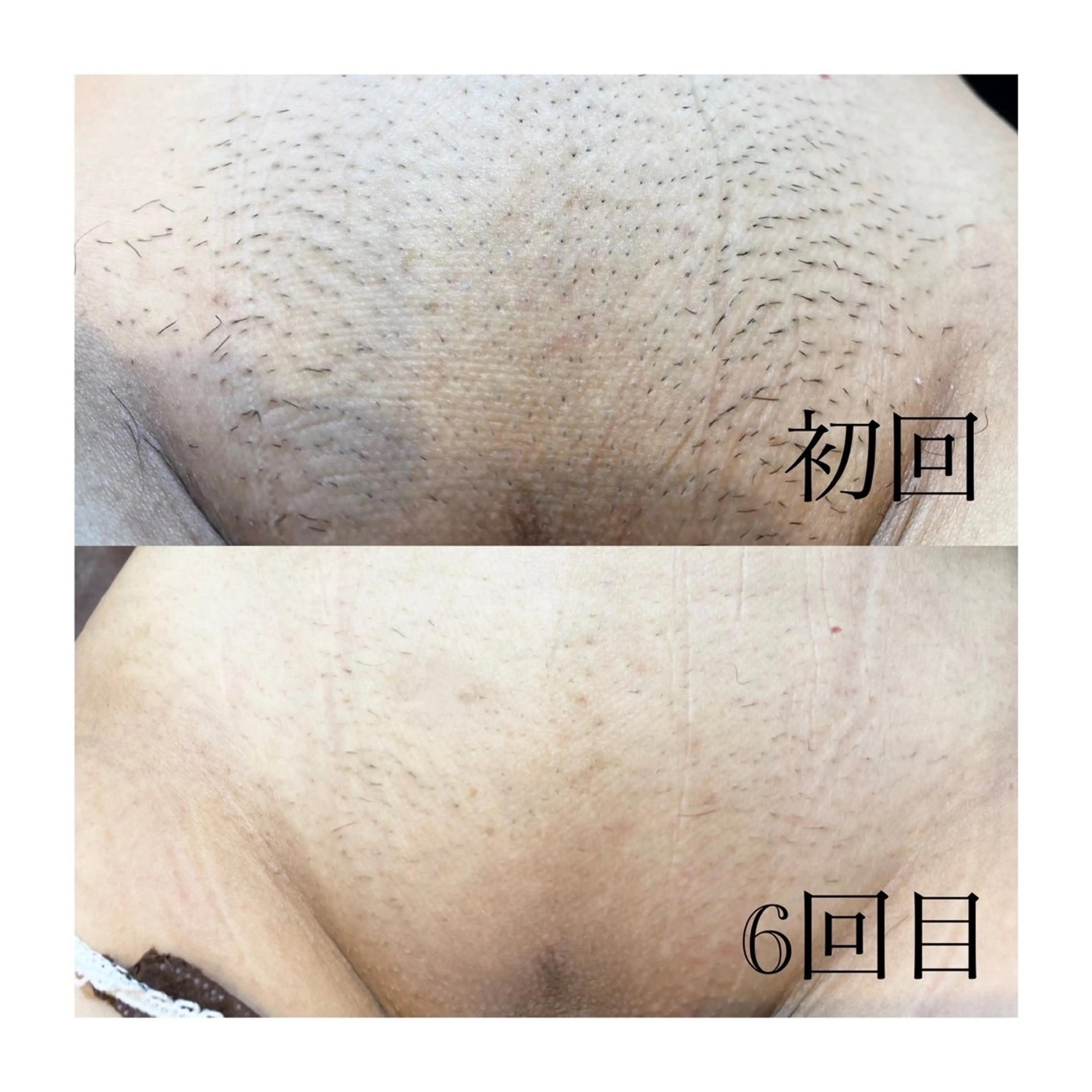 脱毛 温活beautyサロンNeroli所属・切らない脂肪吸引🔥 Neroliまりこのエステ・リラクイメージ