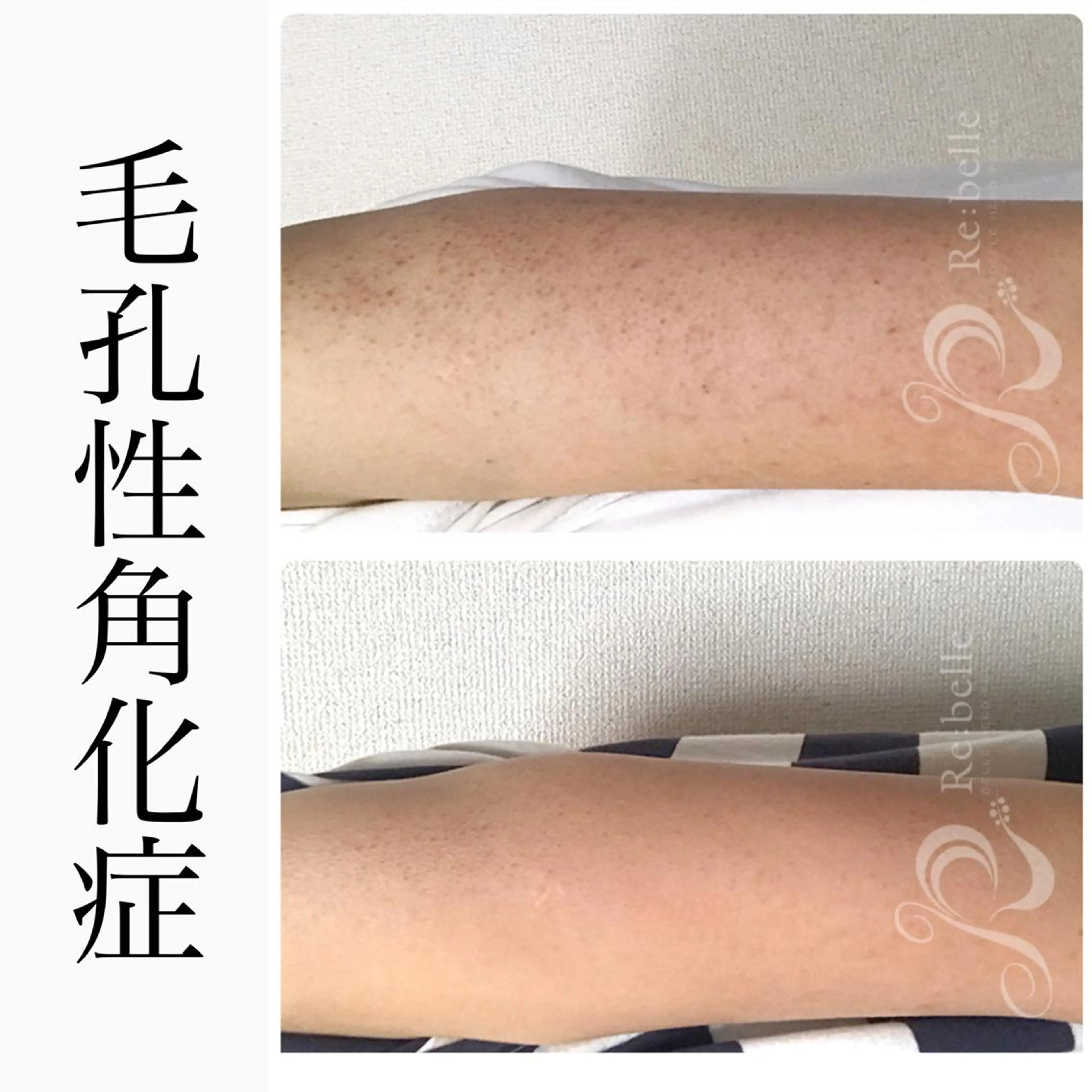 【二の腕ニキビ・毛孔性苔癬】二の腕ハーブピーリング🌿の写真