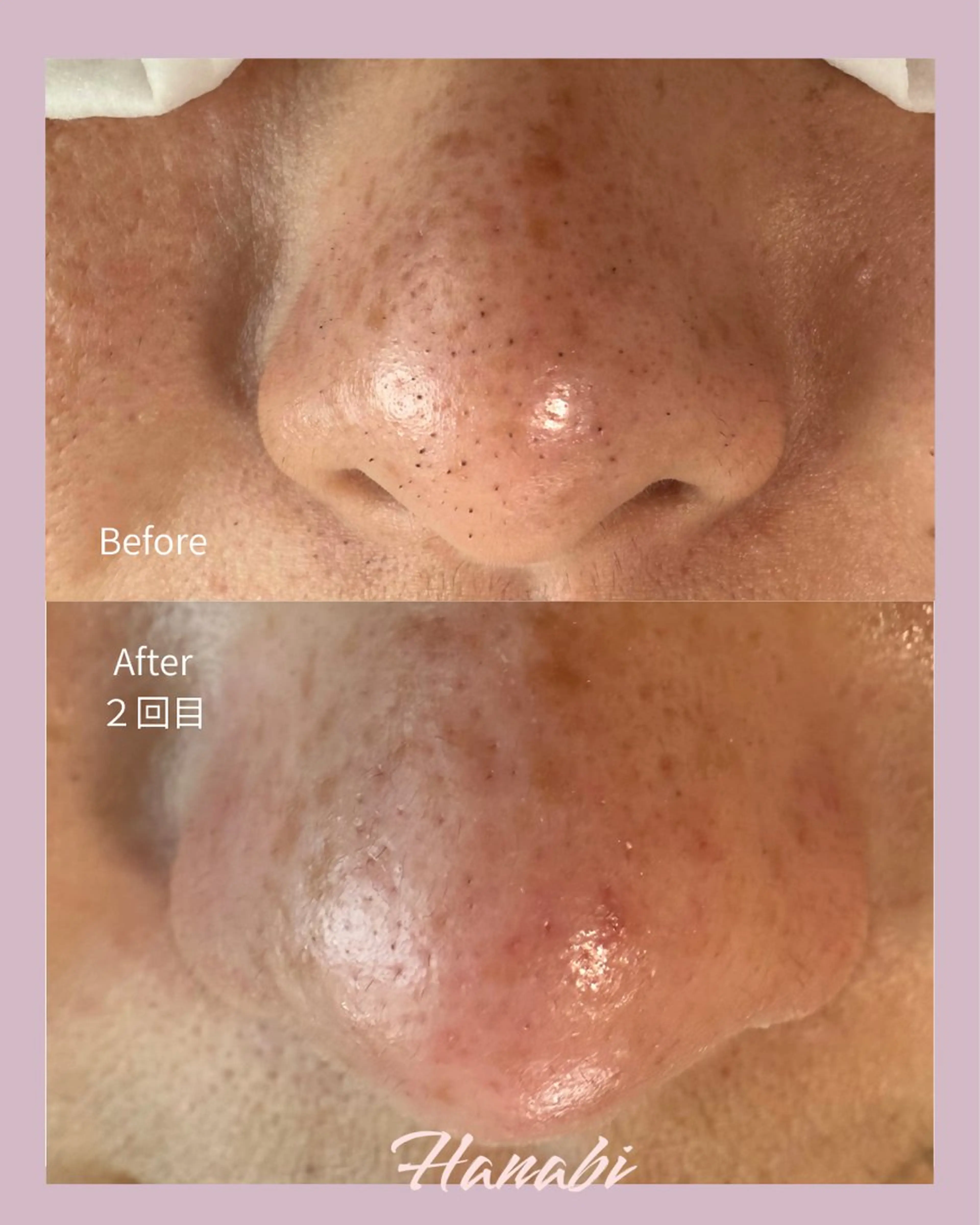 エステ 毛穴専門サロン Hanabiのエステ・リラクイメージ