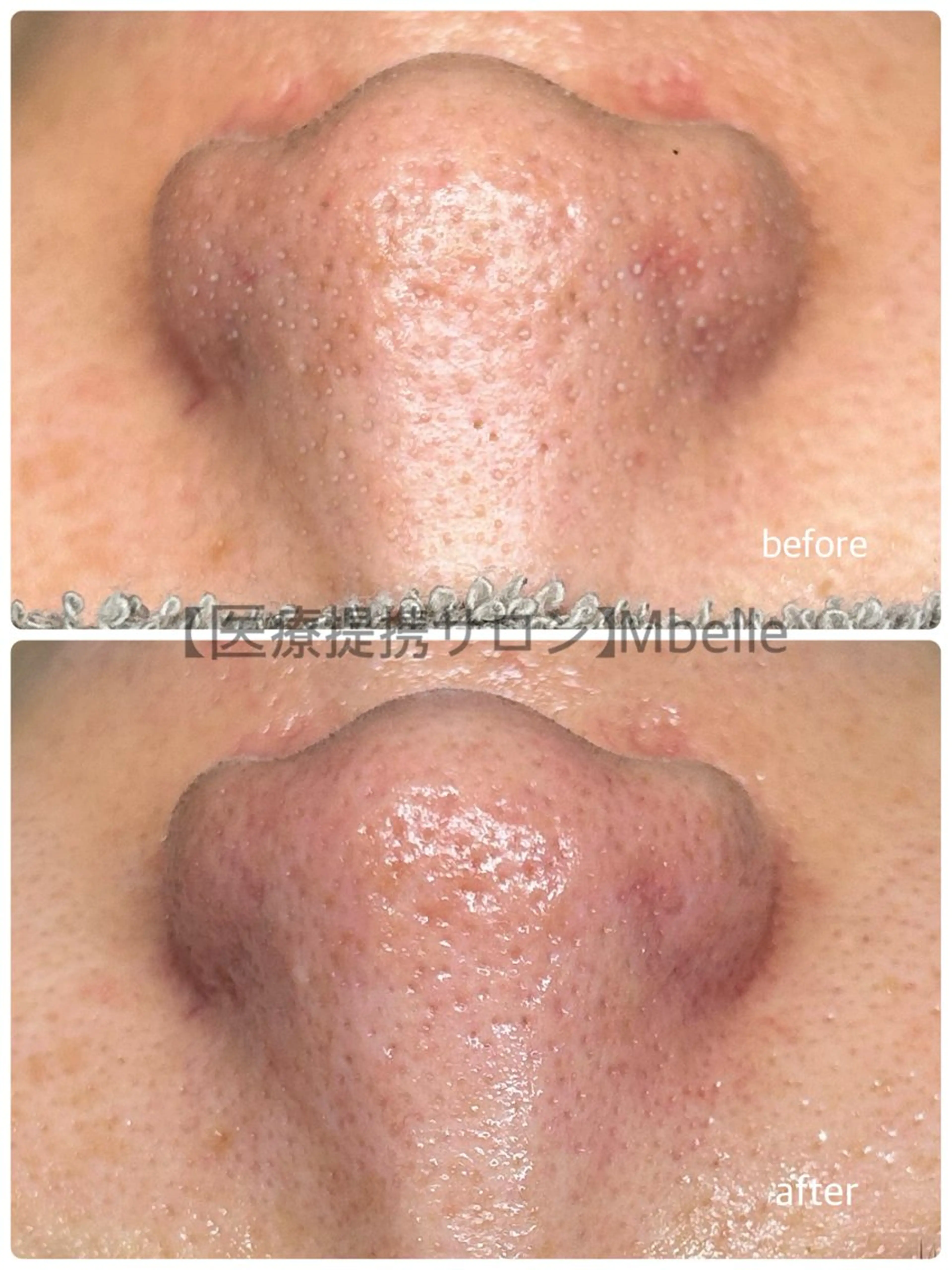 肌質改善Mbelle 越谷レイクタウン🌿のエステ・リラクイメージ