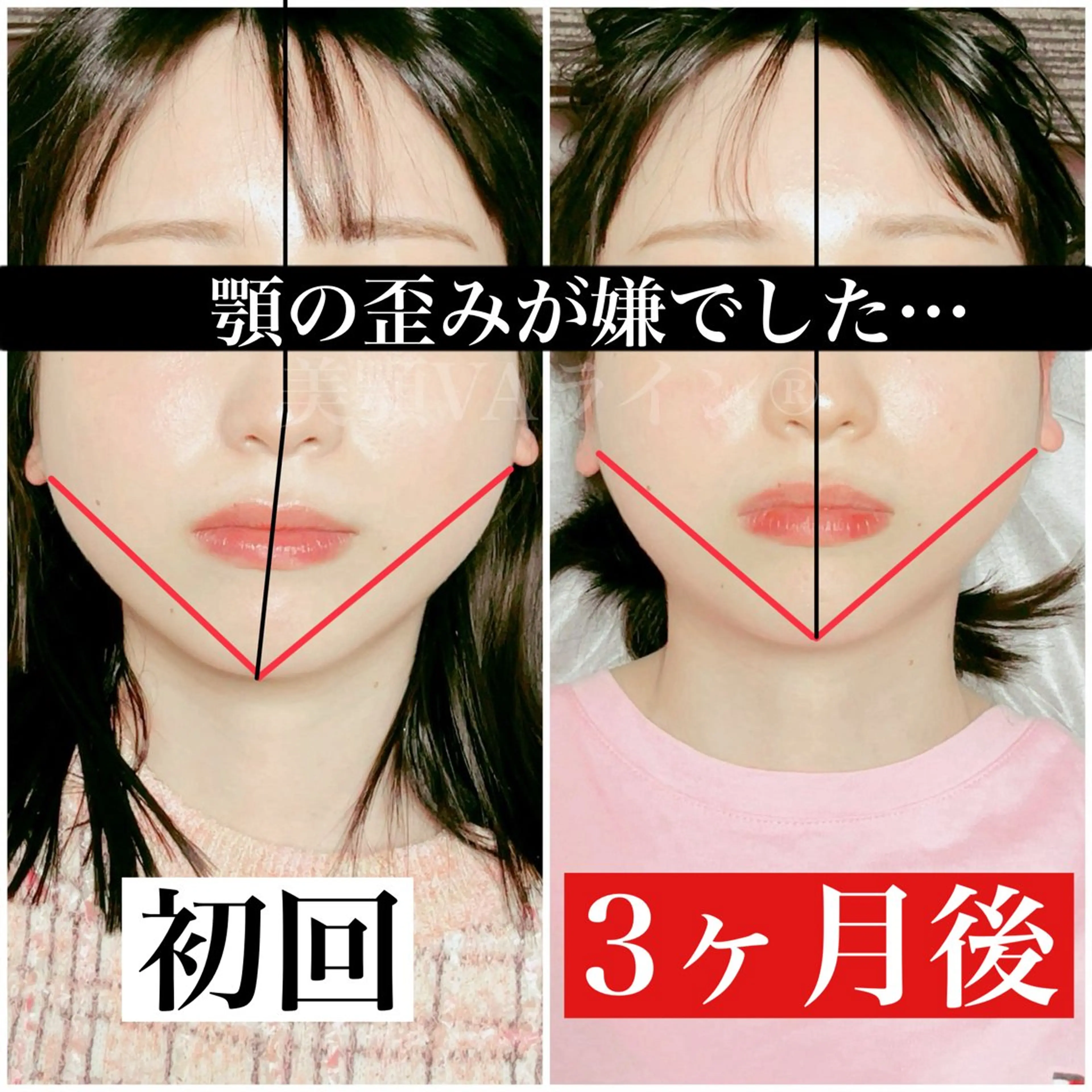 minimo特別❣️あご+頭蓋骨小顔矯正 💆🏻♀️ 顔の歪み 全部込み❤️ お試しパーフェクトコースの写真