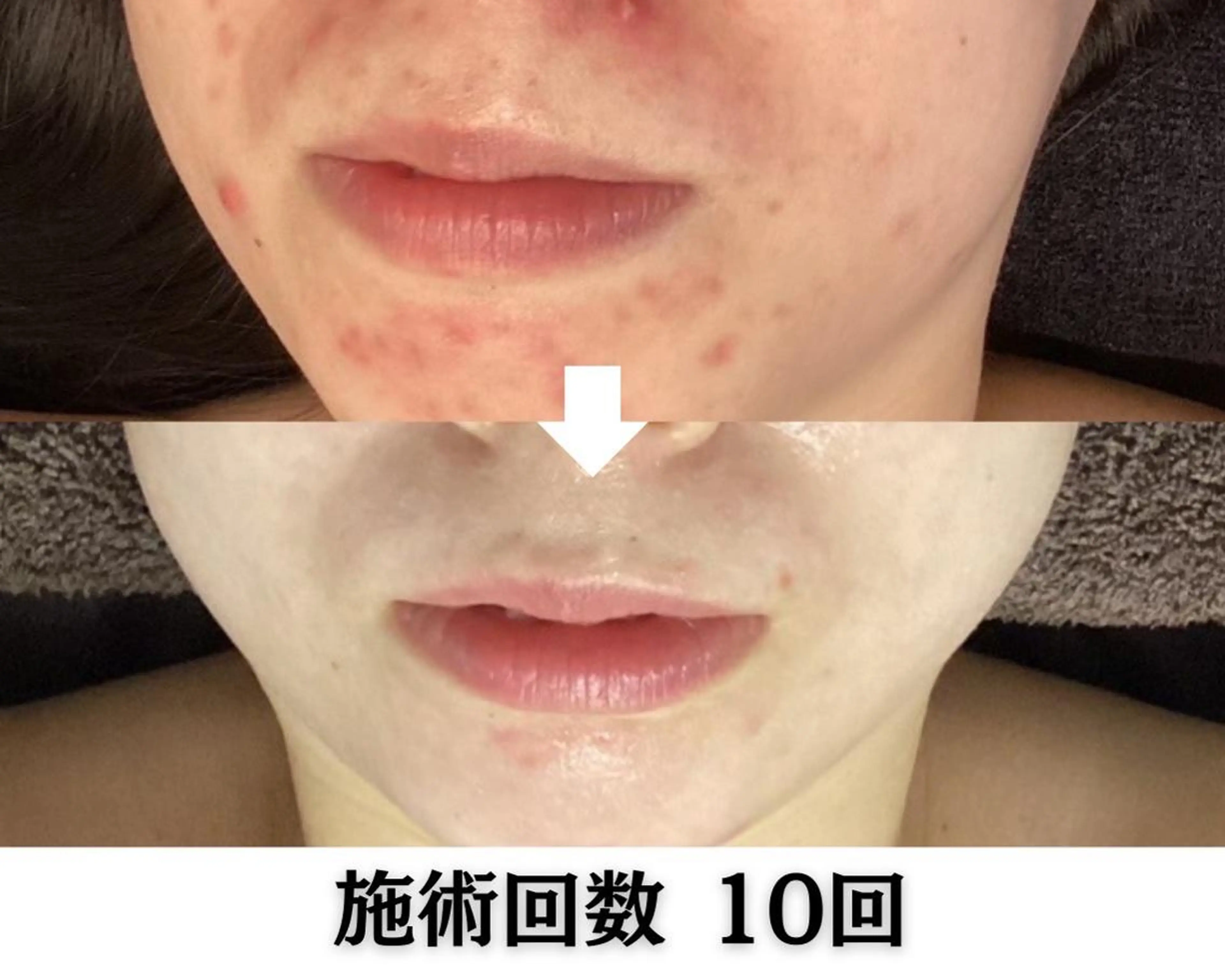 池袋毛穴ニキビ改善 ハーブピーリングのエステ・リラクイメージ