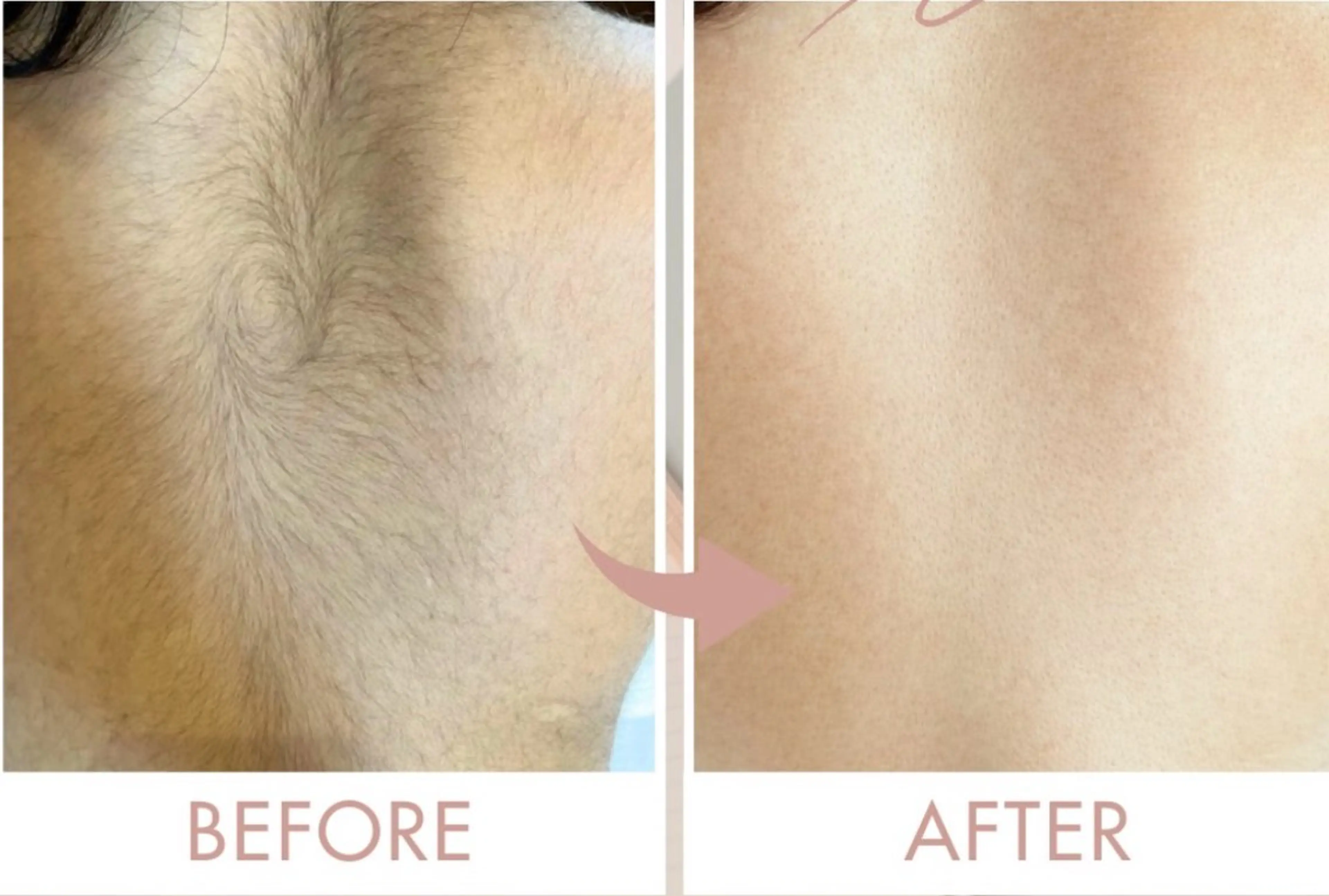 脱毛 RILsalon 脱毛/フェイシャルのエステ・リラクイメージ