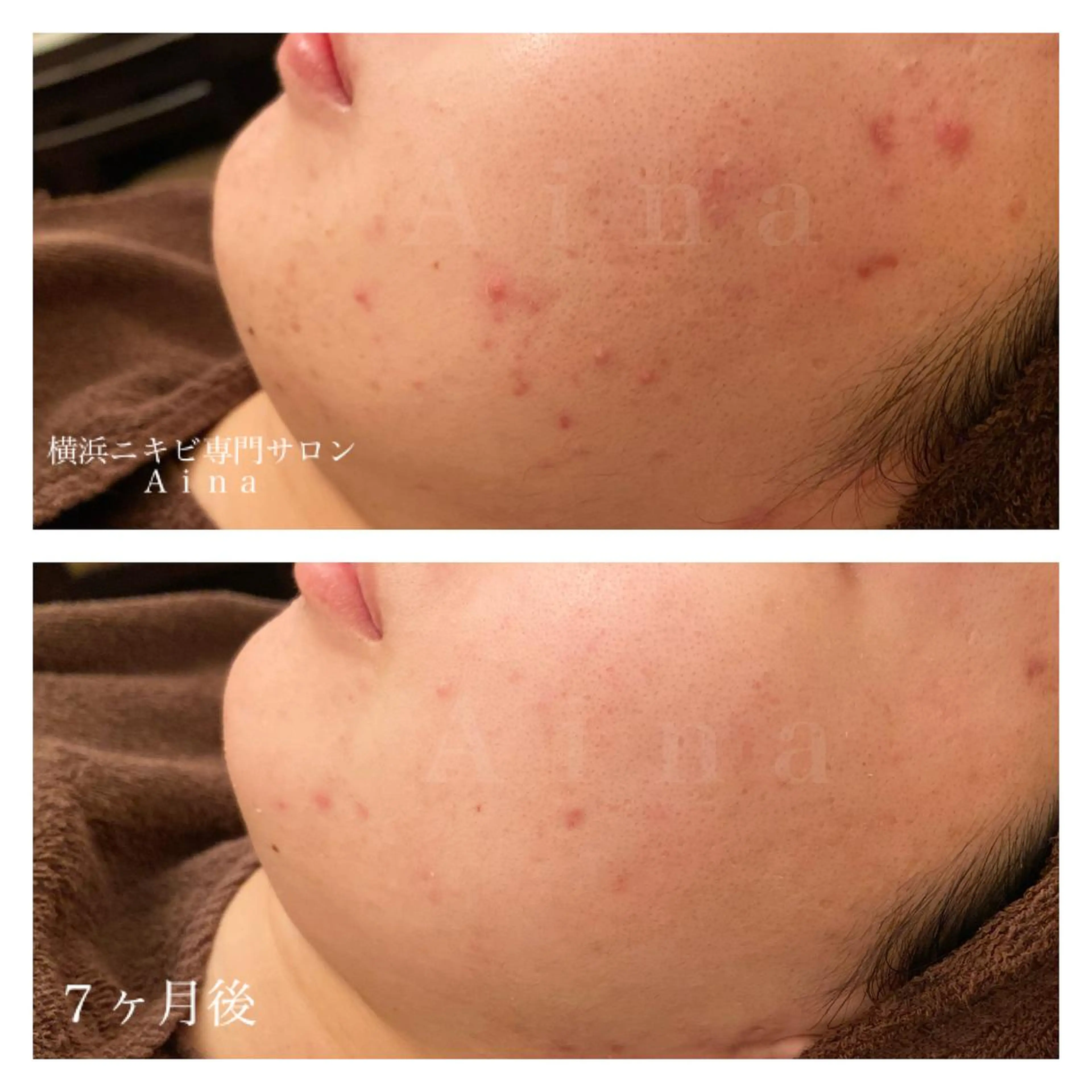 ミディアム カラー パーマ ヘアアレンジ メンズ キッズ ネイル マツエク・マツパ ニキビ跡専門サロン Ａｉｎａのエステ・リラクイメージ