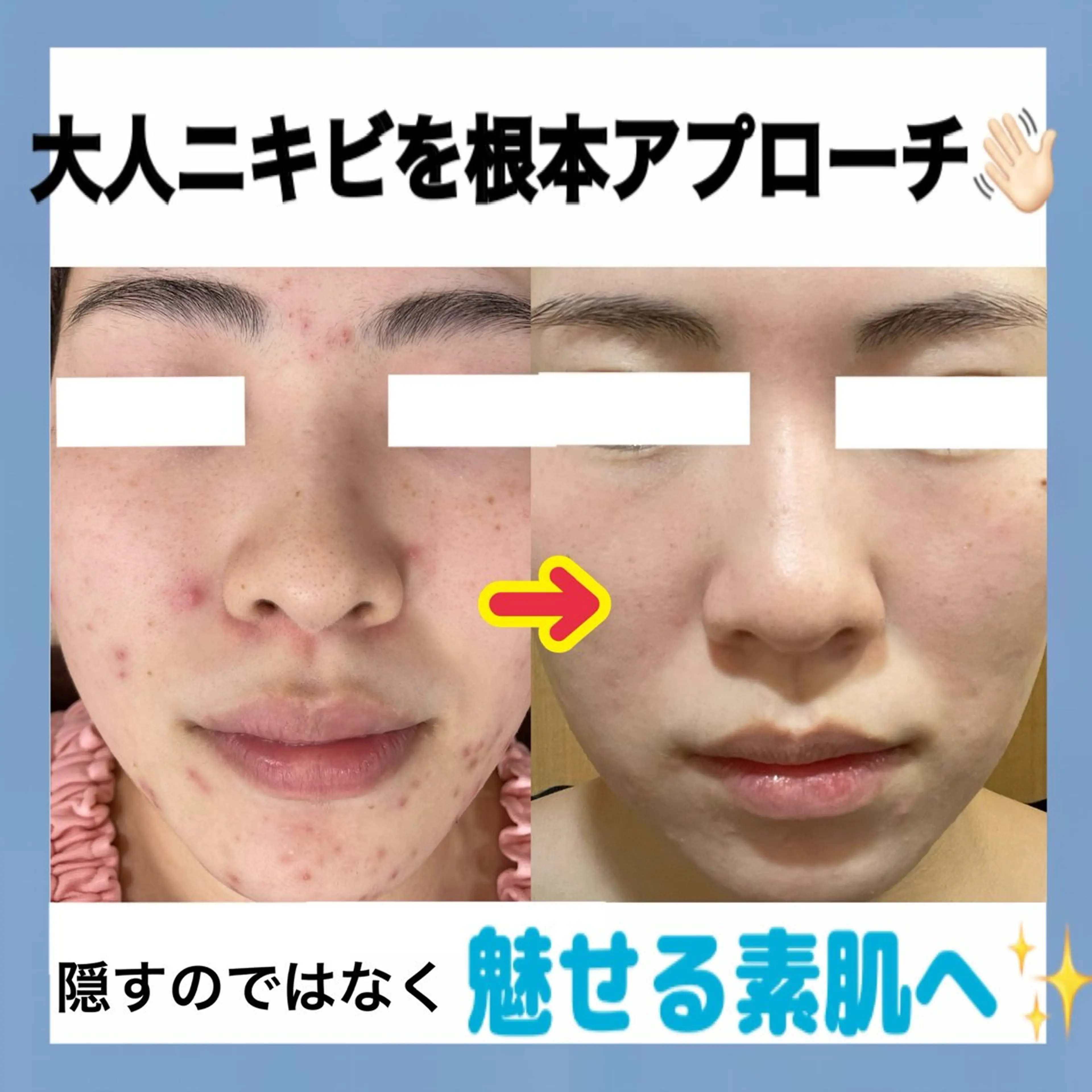 【ニキビを殺菌&予防】ニキビ集中ケアコースの写真