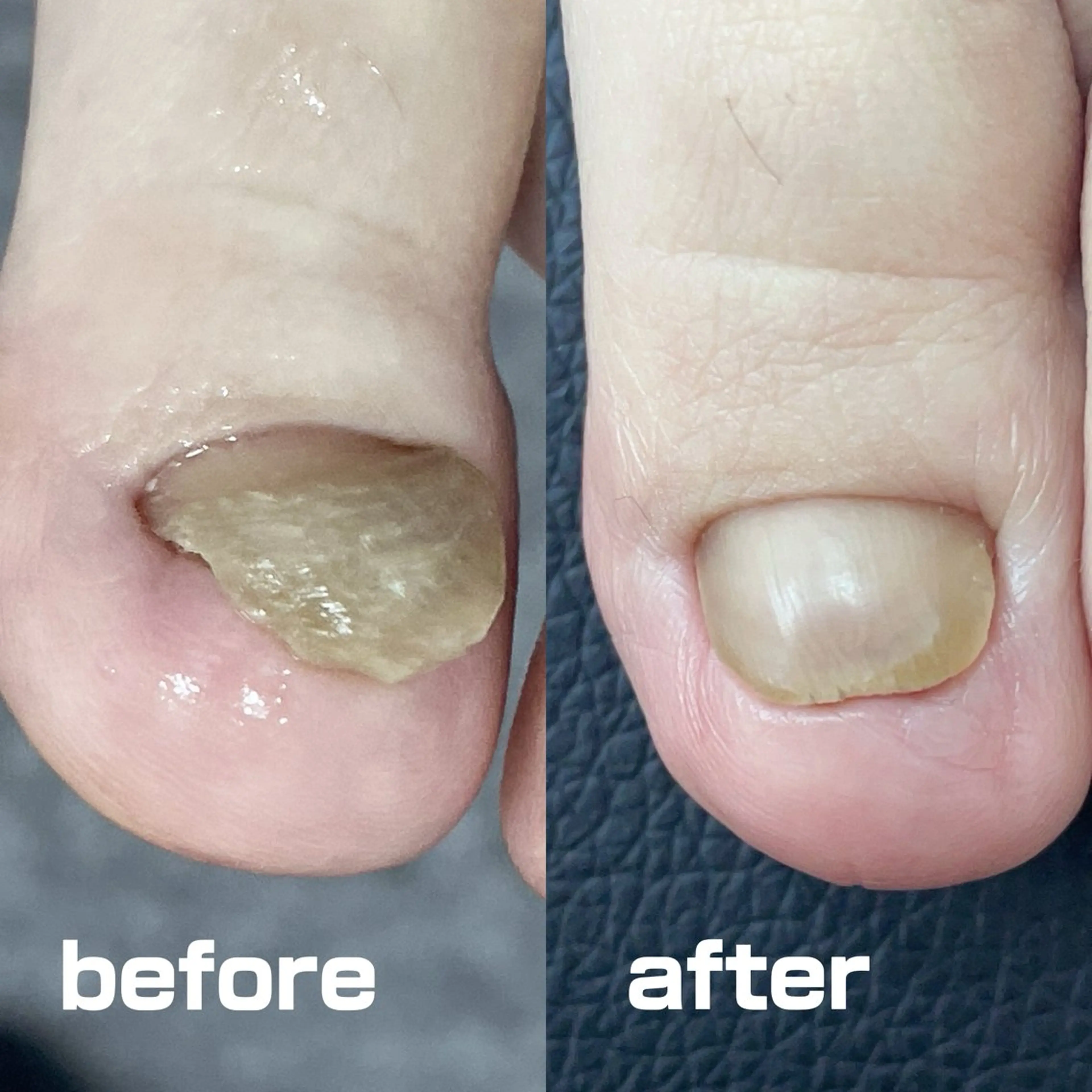 肥厚爪・爪甲鉤彎症リスタートケア 初回1趾の写真