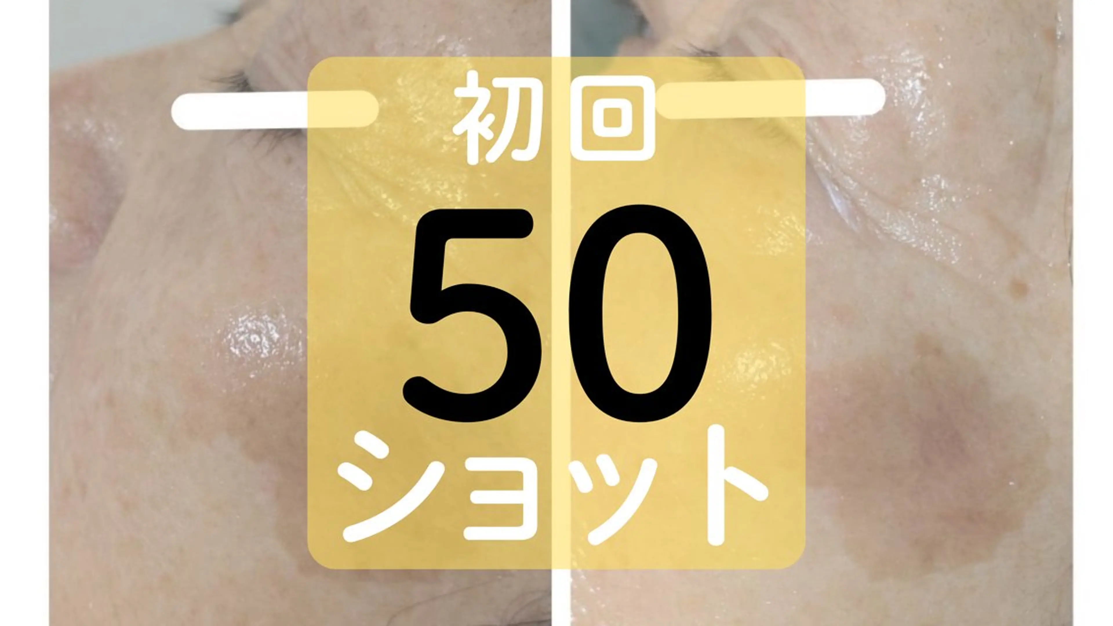 【初回価格】シワ・シミ・くすみなどお顔上部or下部のケアに 25ショットの写真