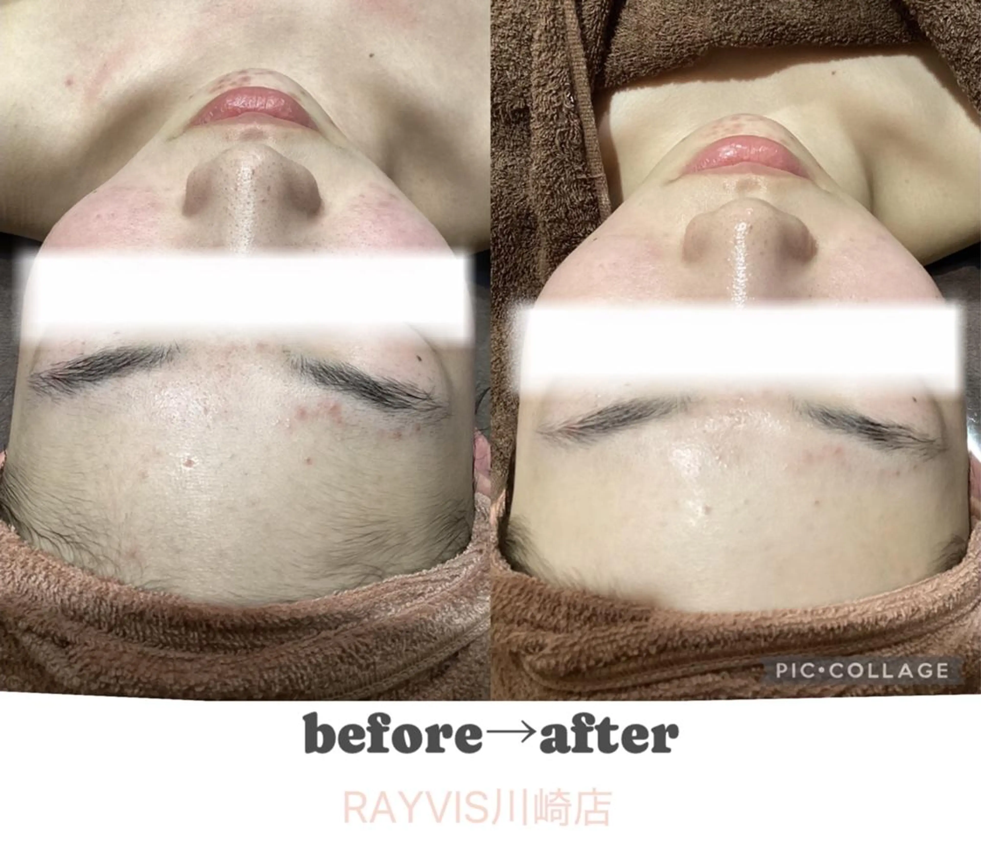 脱毛 🌷毛穴エステ レイビスMURA🌷のエステ・リラクイメージ