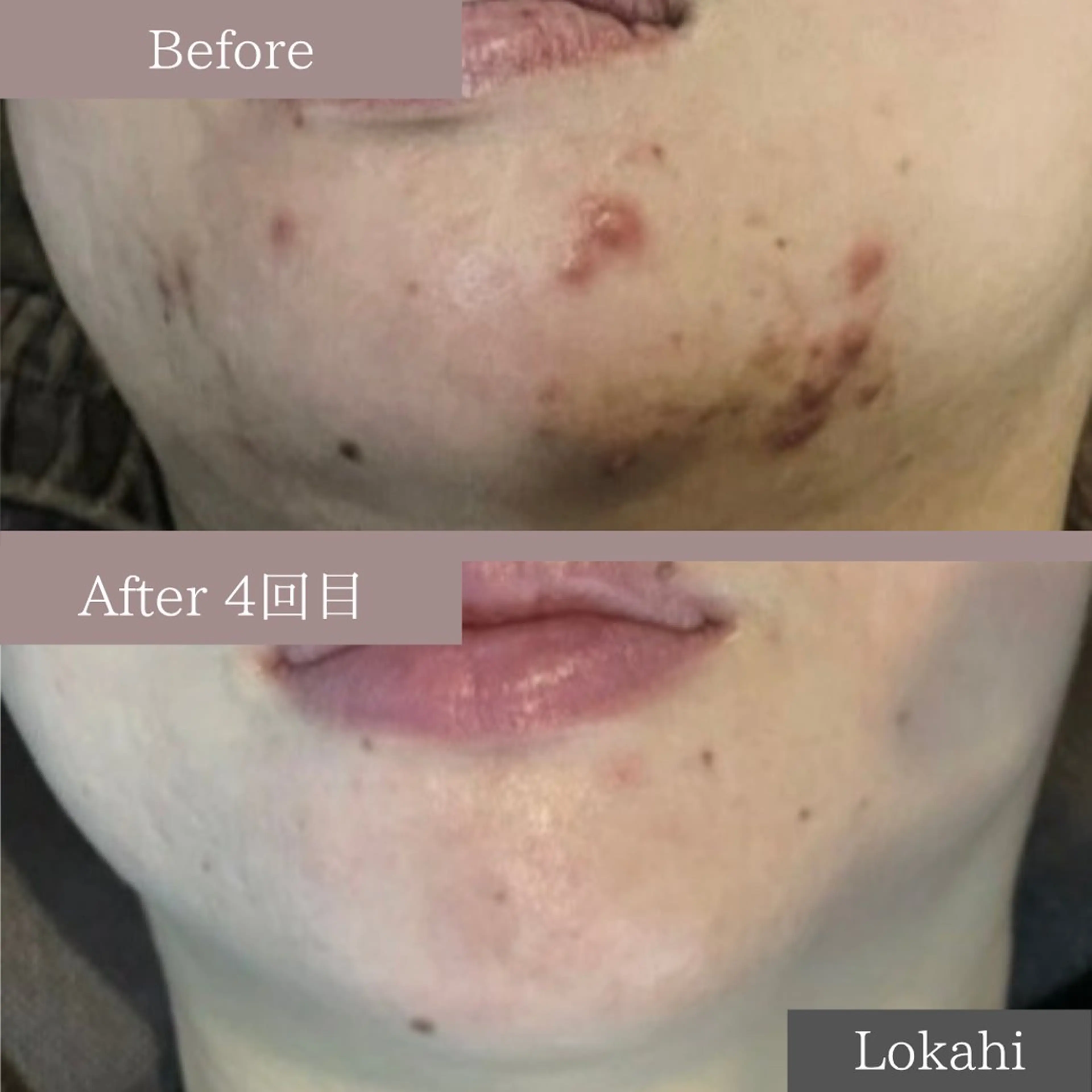 エステ 全身脱毛／リラク Lokahiのエステ・リラクイメージ