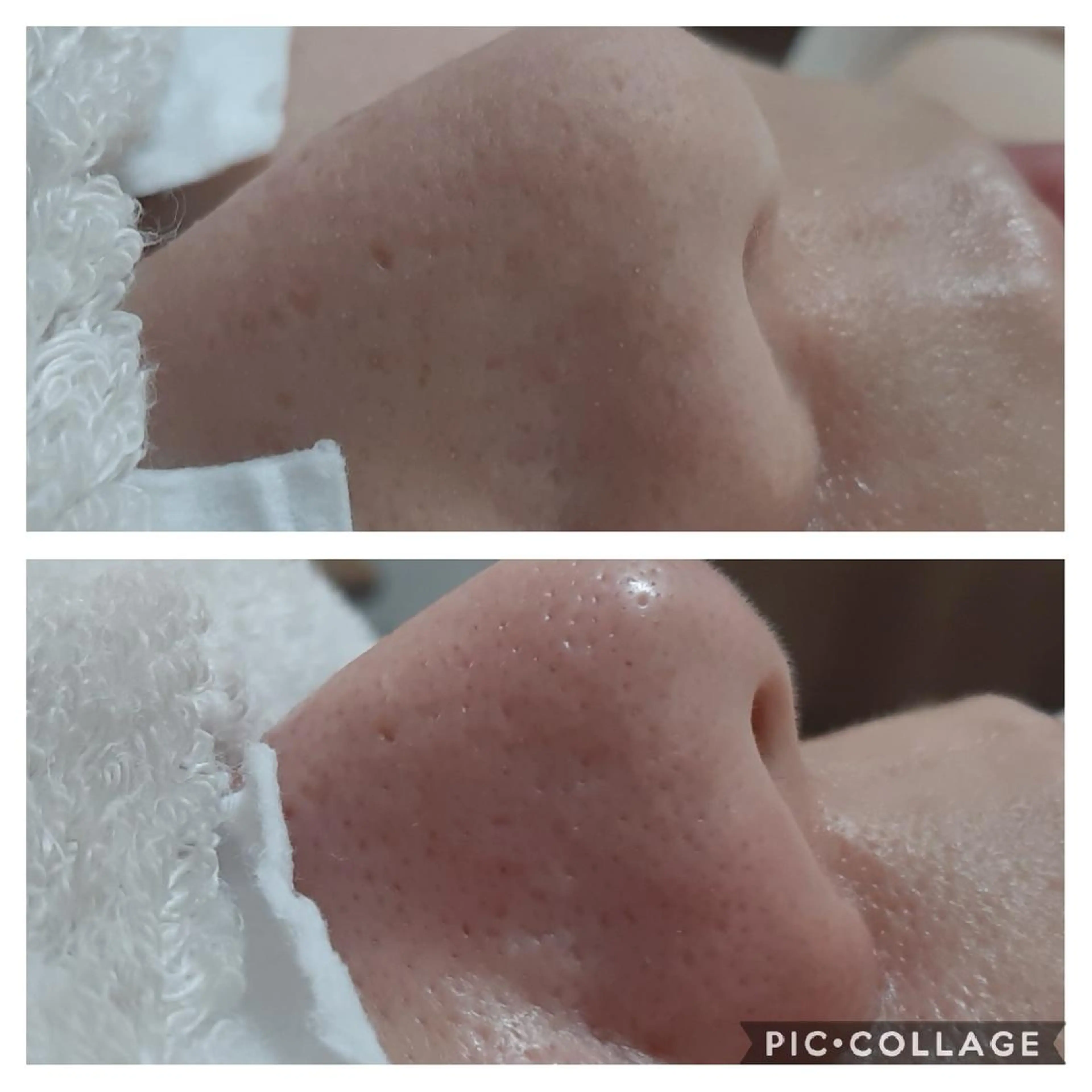 毛穴ケア・肌質改善 徳川のエステ・リラクイメージ