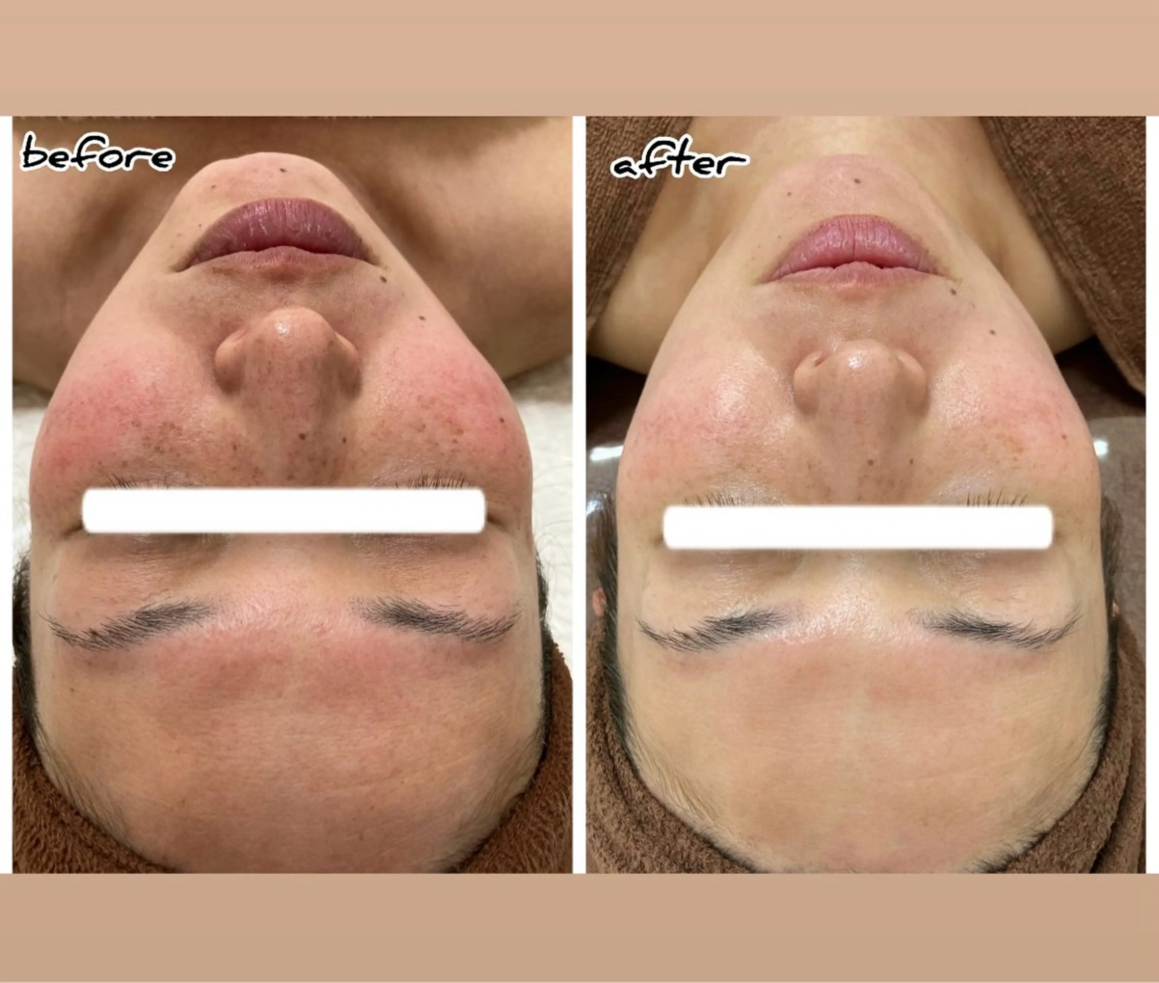 お悩みNO1😫毛穴&シミを改善しましょう！！の写真