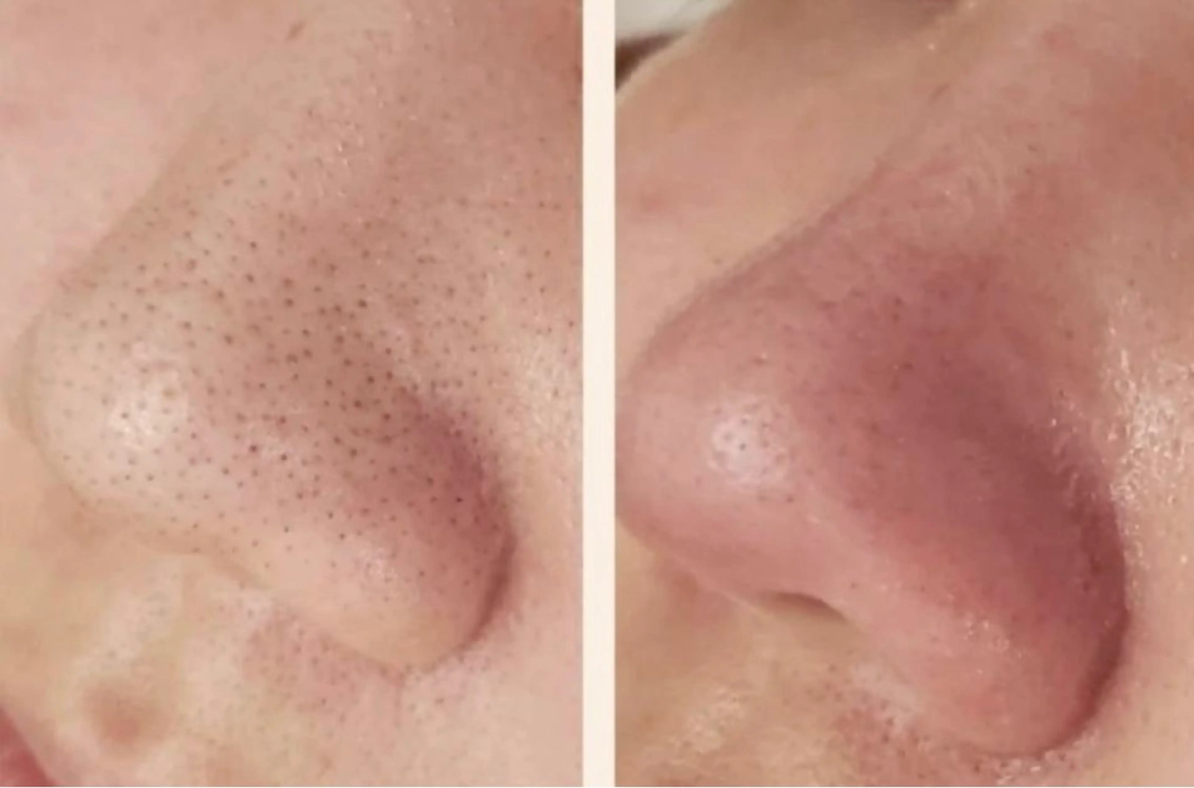 【ミニモ限定】鼻 毛穴エクストラクションの写真