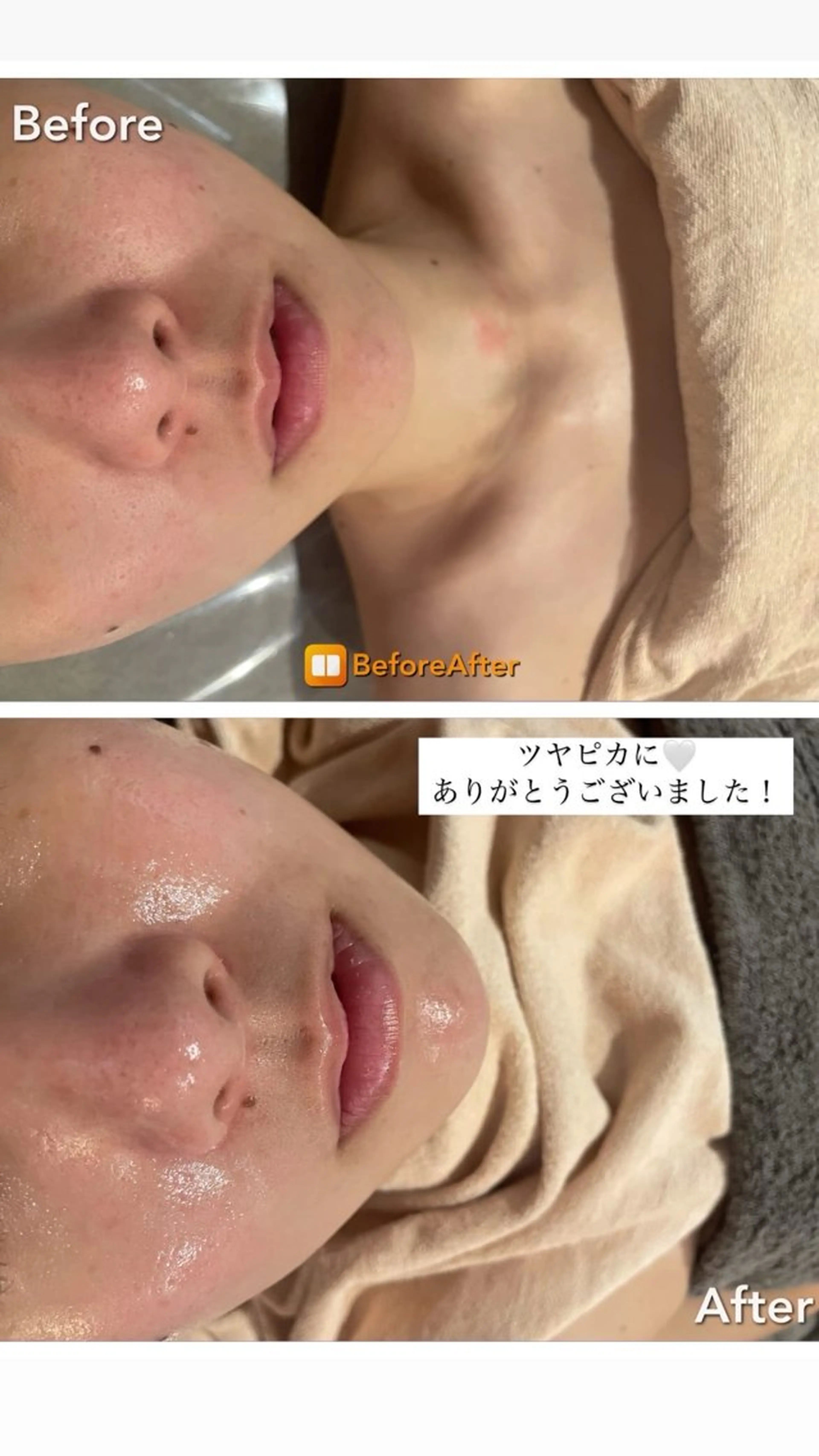 エステ Meupニキビ専門店 背中/ハーブ/肌管理のその他イメージ