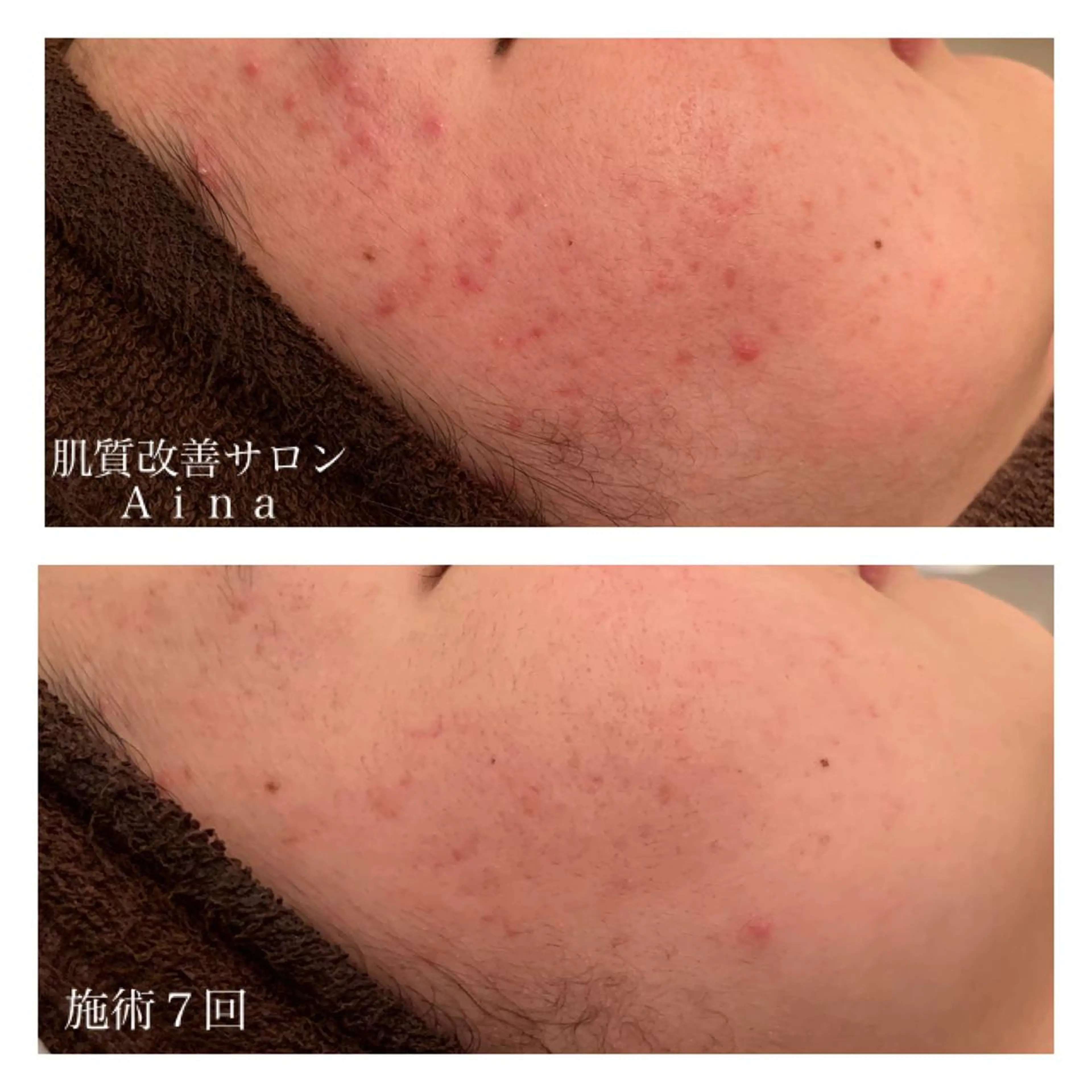 ミディアム カラー パーマ ヘアアレンジ メンズ キッズ ネイル マツエク・マツパ 赤色 ニキビ跡専門サロン Ａｉｎａのエステ・リラクイメージ